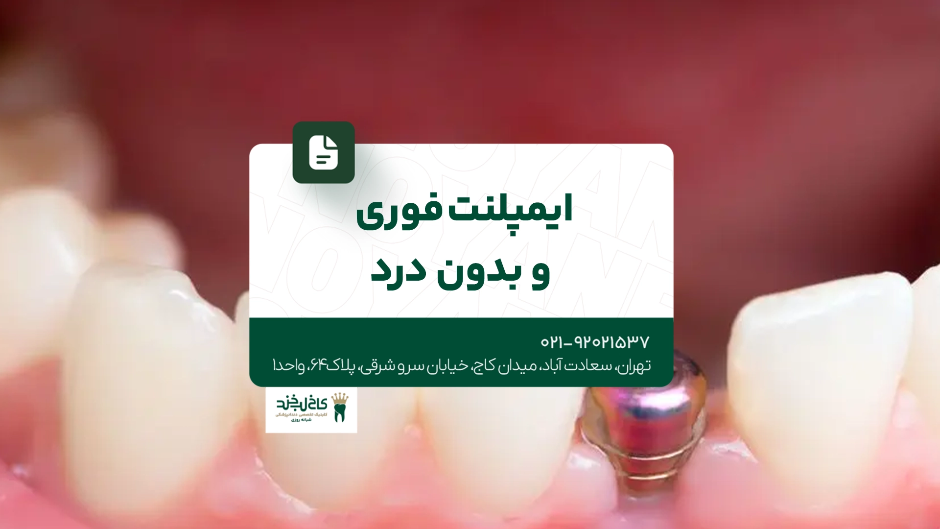 ایمپلنت فوری و بدون درد ایمپلنت فوری و بدون درد