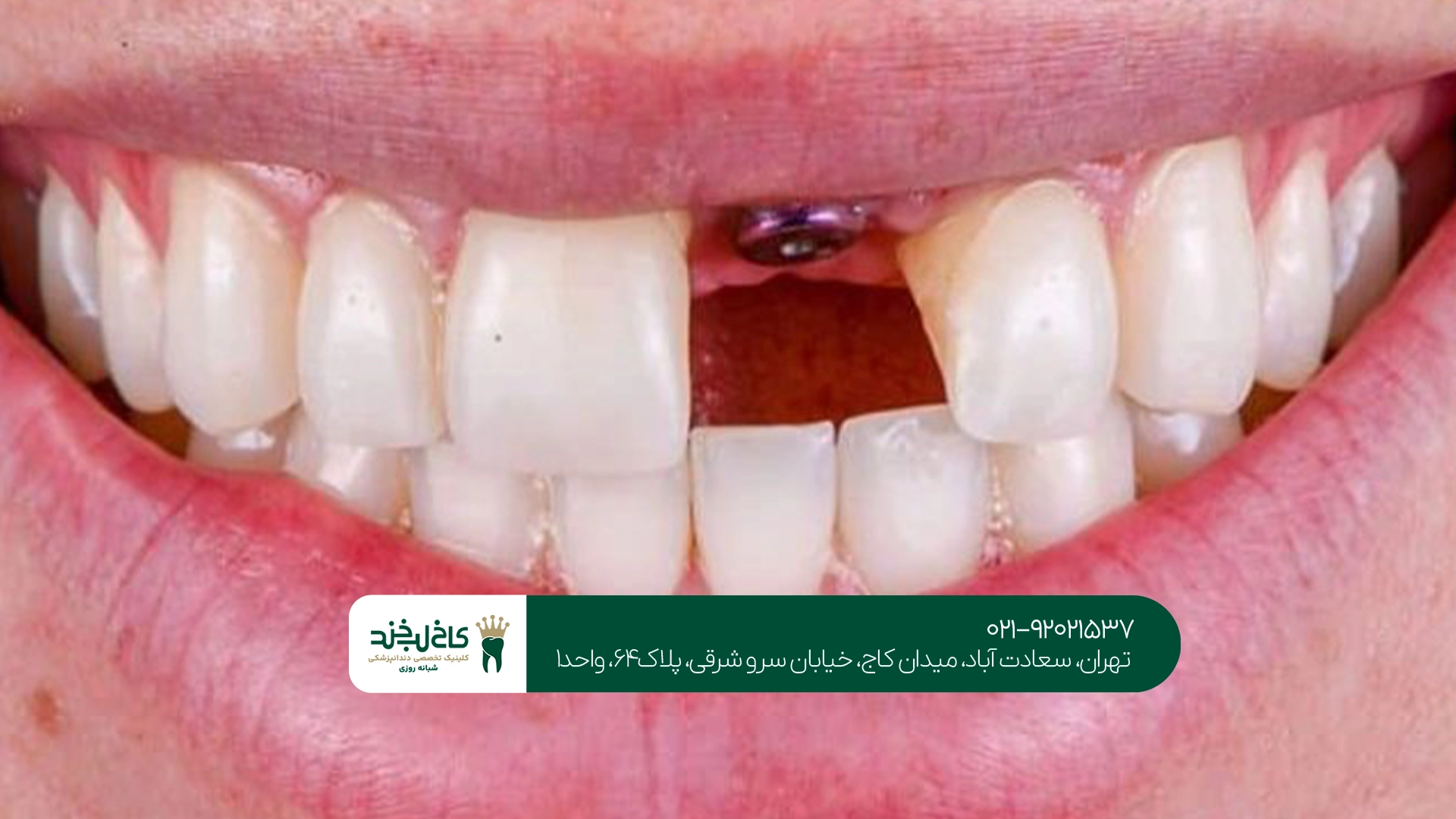ایمپلنت فوری در تهران ایمپلنت فوری در تهران