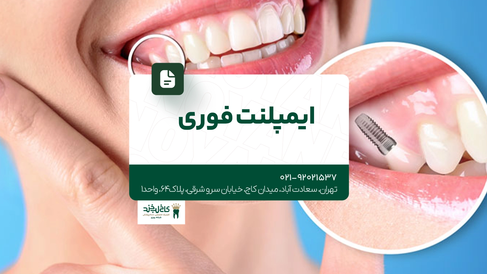 ایمپلنت فوری ایمپلنت فوری