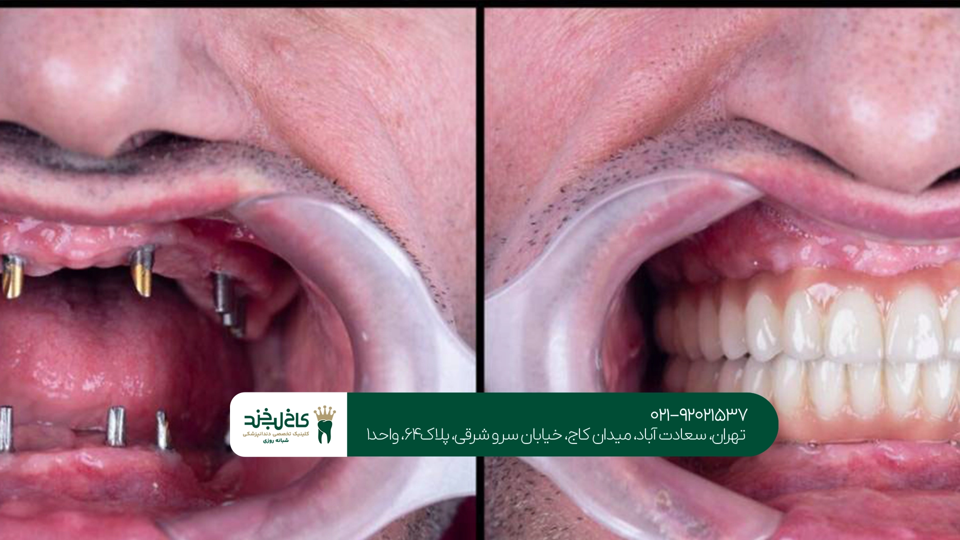 ایمپلنت فول فک در تهران