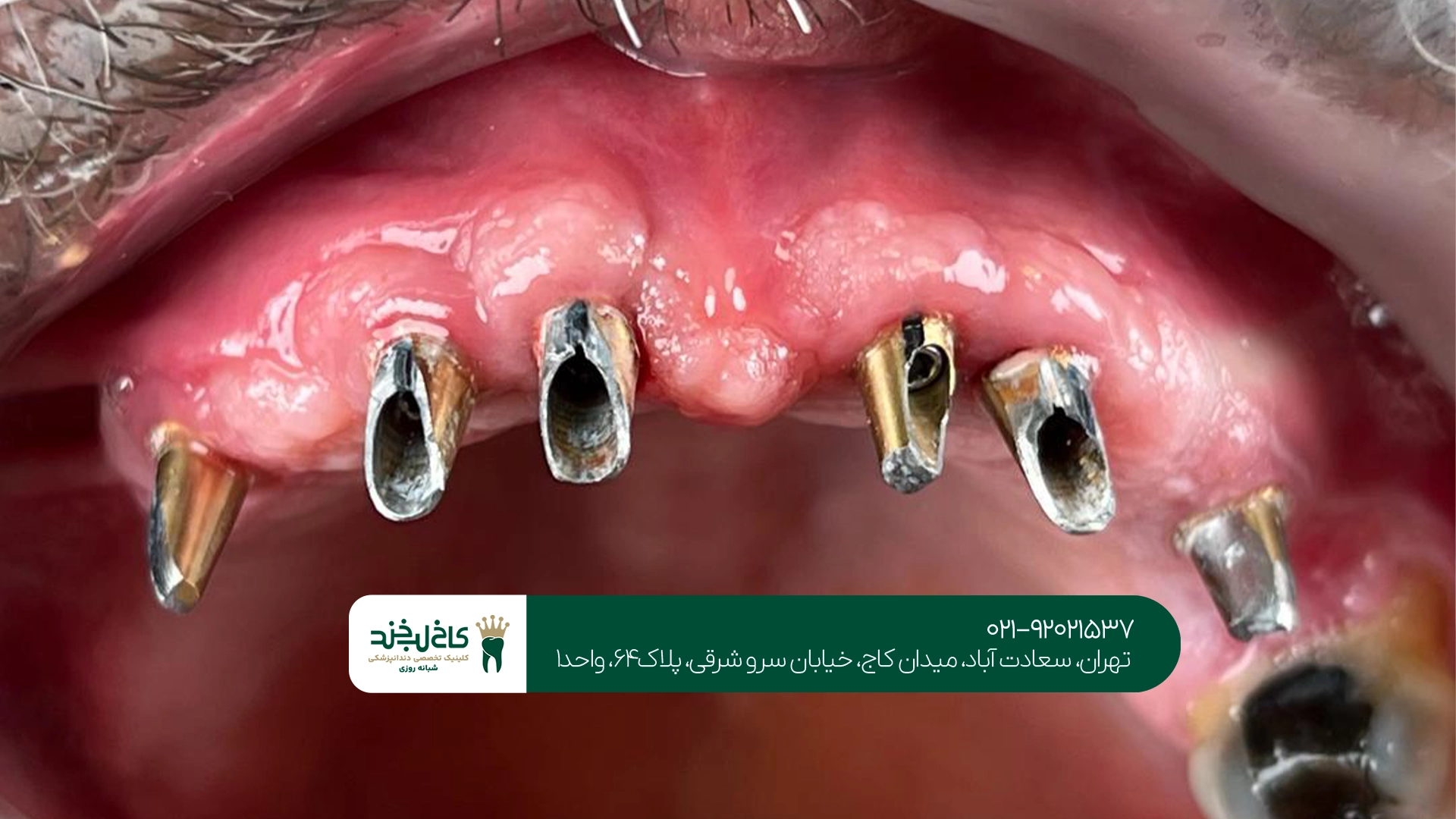 ایمپلنت فول فک در تهران
