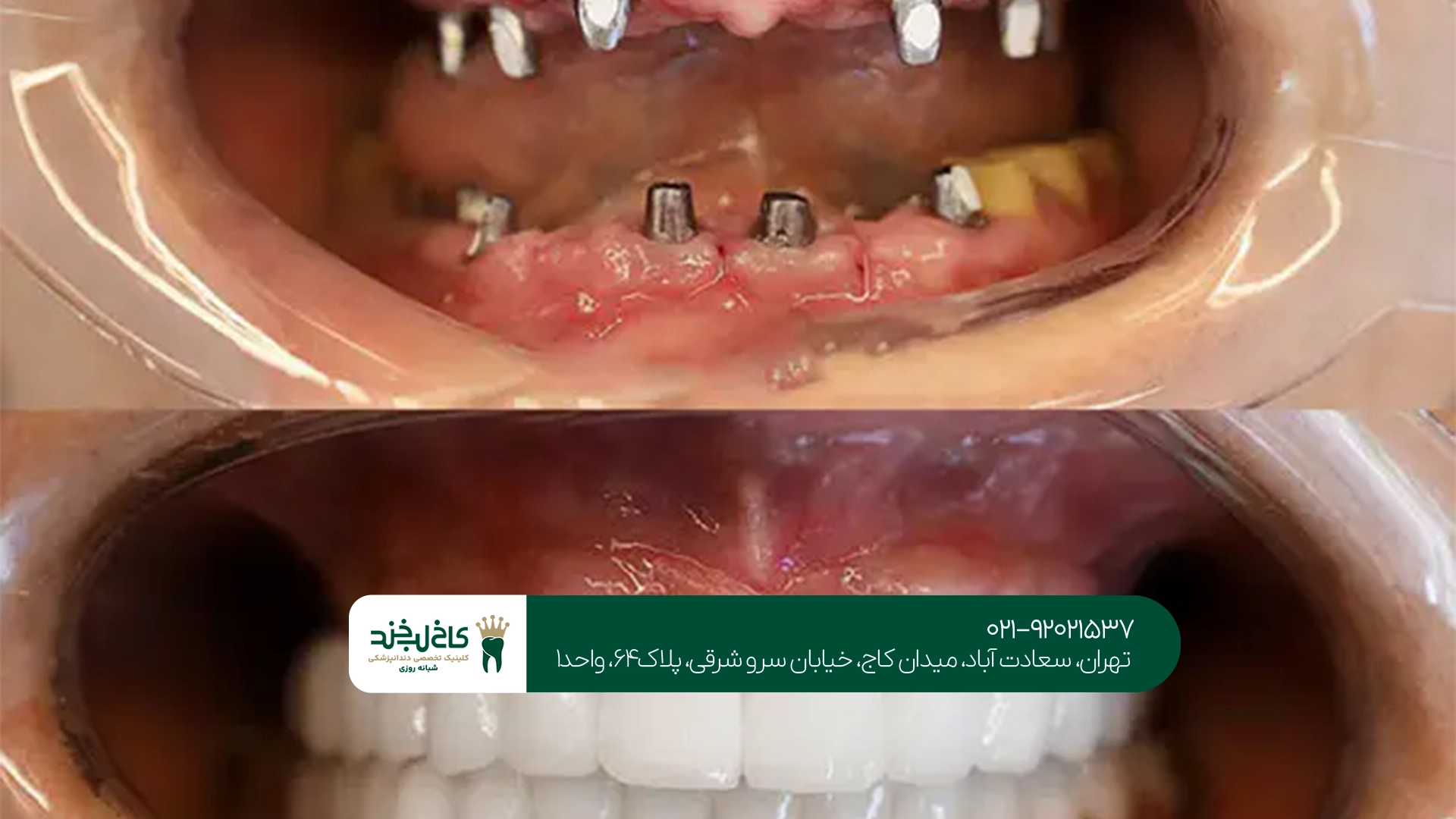 ایمپلنت فول فک در تهران