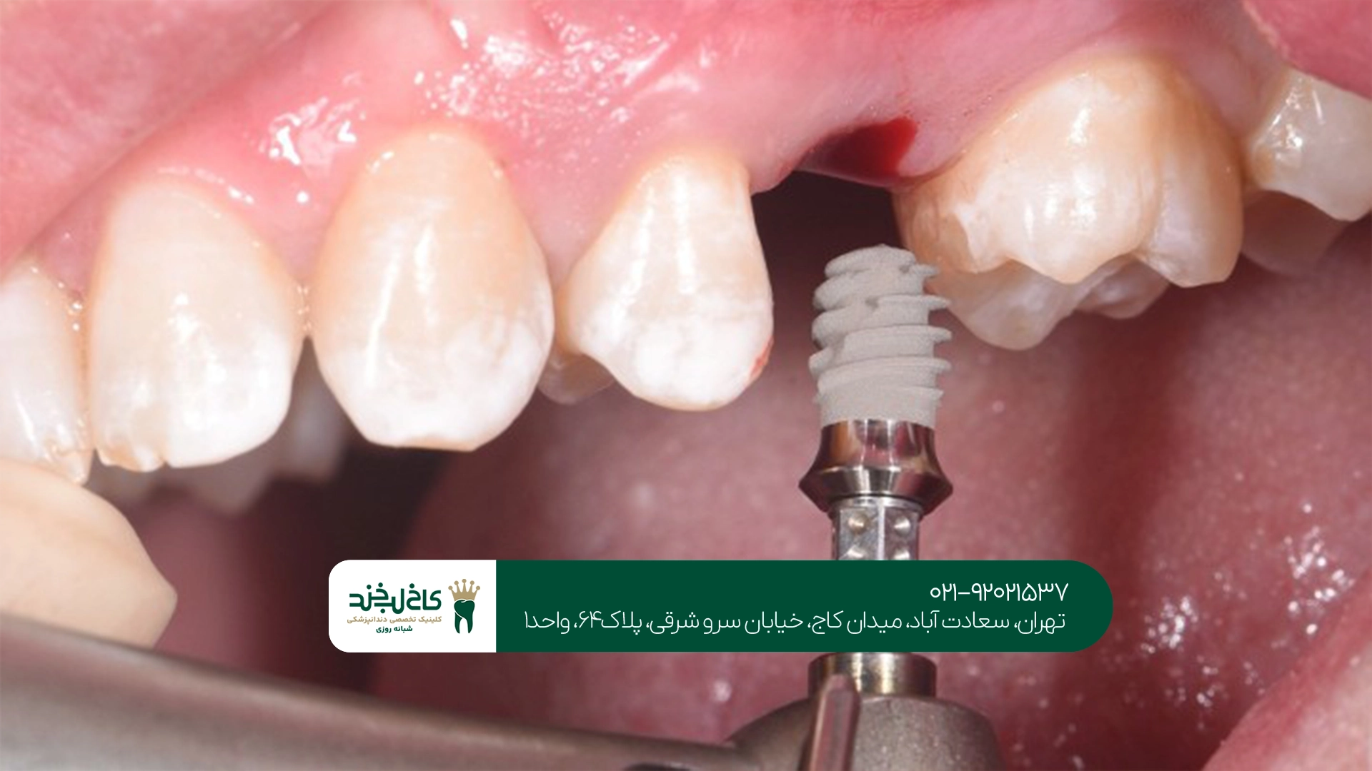 تفاوت چهره قبل و بعد از ایمپلنت دندان