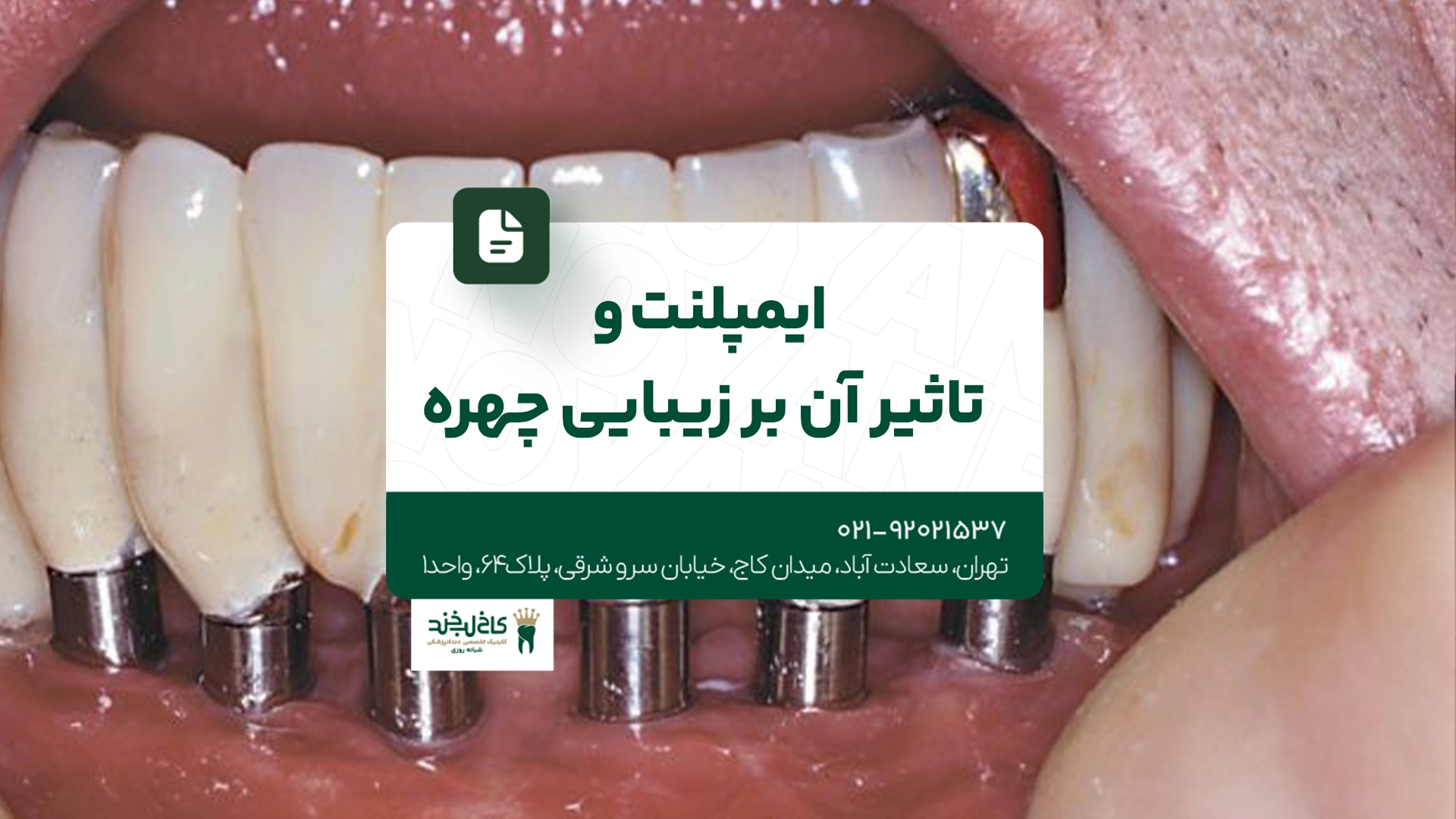 ایمپلنت و تاثیر آن بر زیبایی چهره