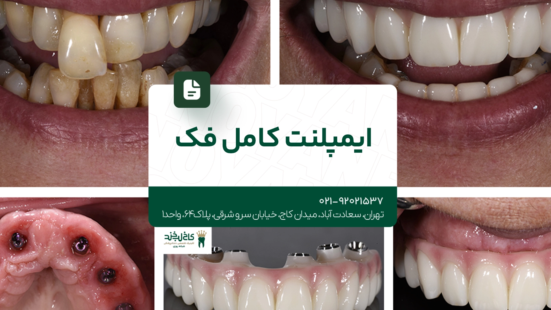 ایمپلنت کامل فک