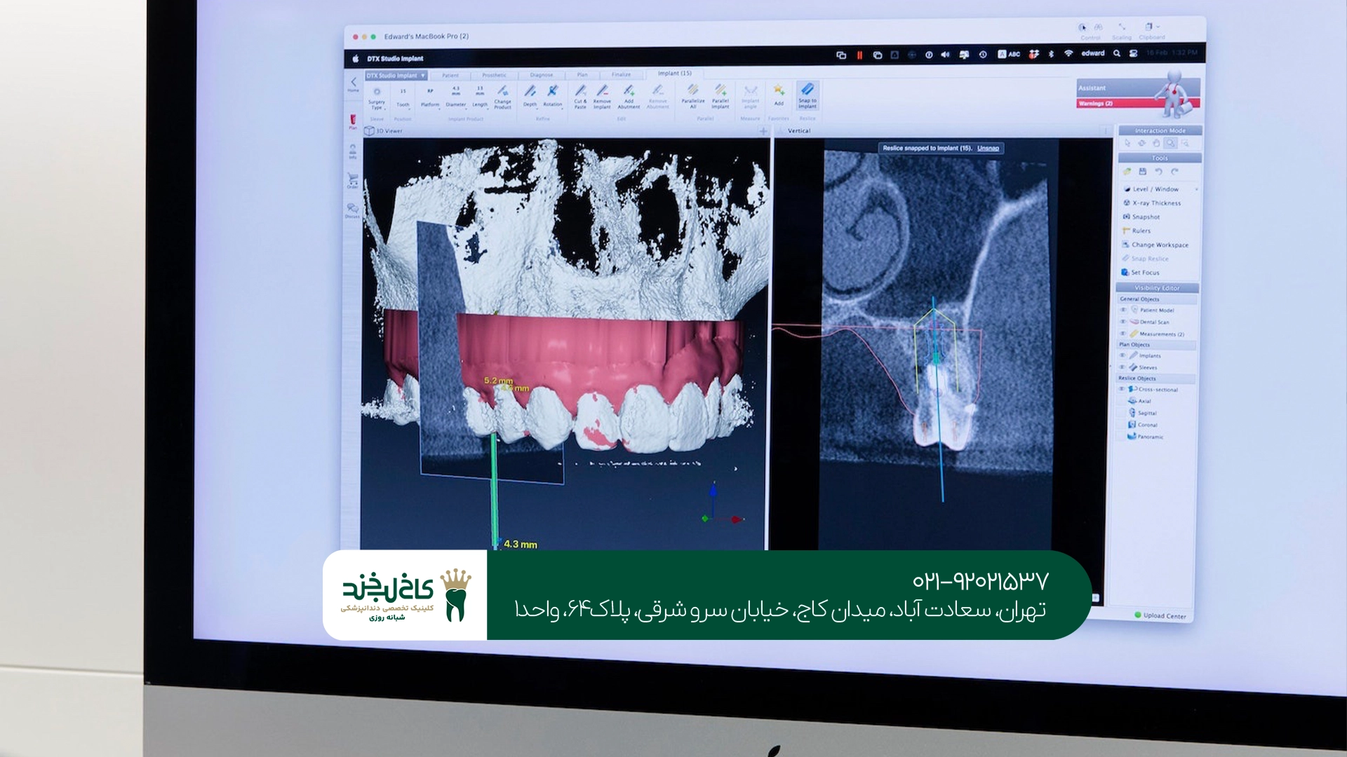 مزایای ایمپلنت یک روزه