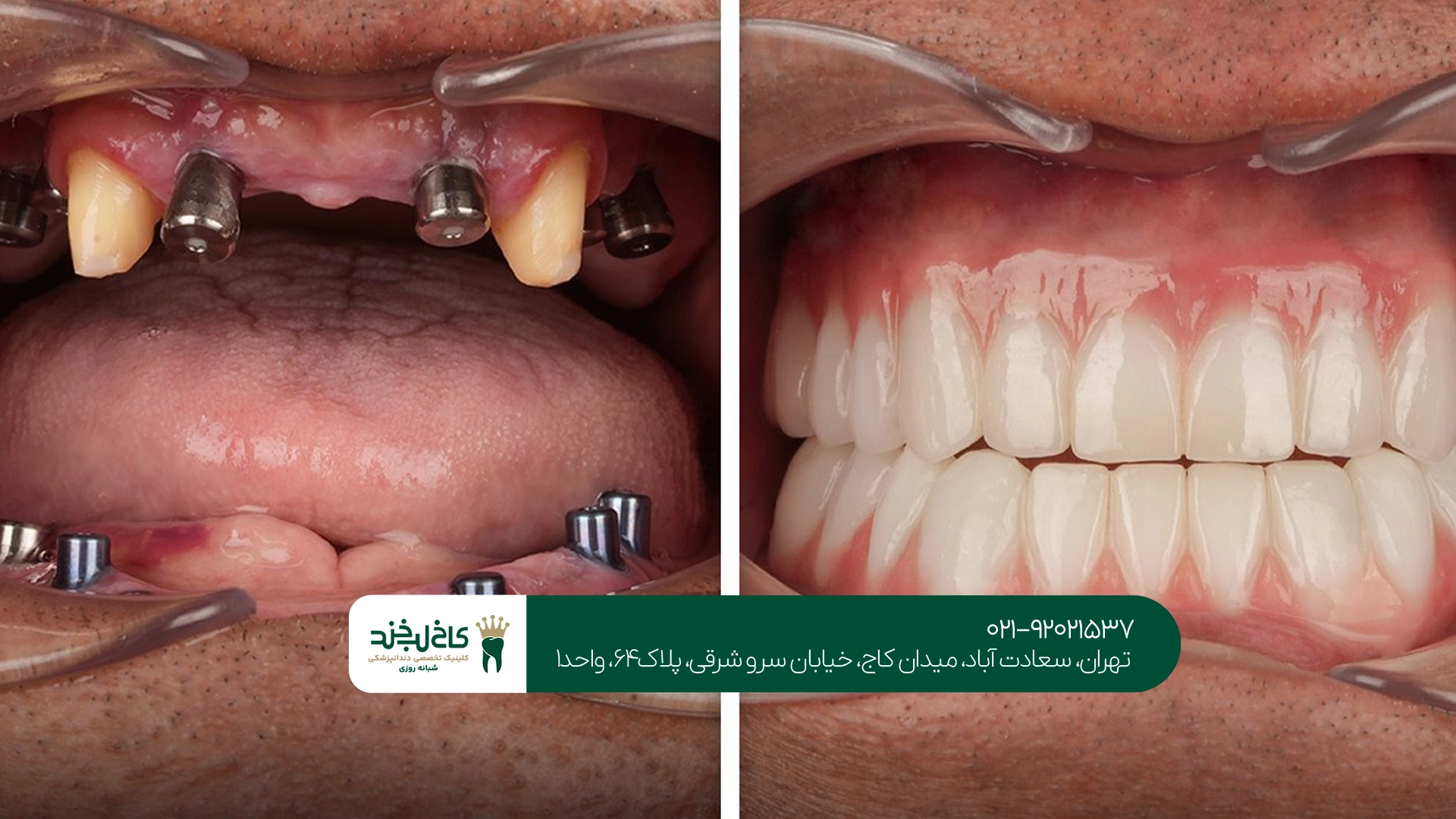 بریج دندان برای چه افرادی انتخاب بهتری است؟