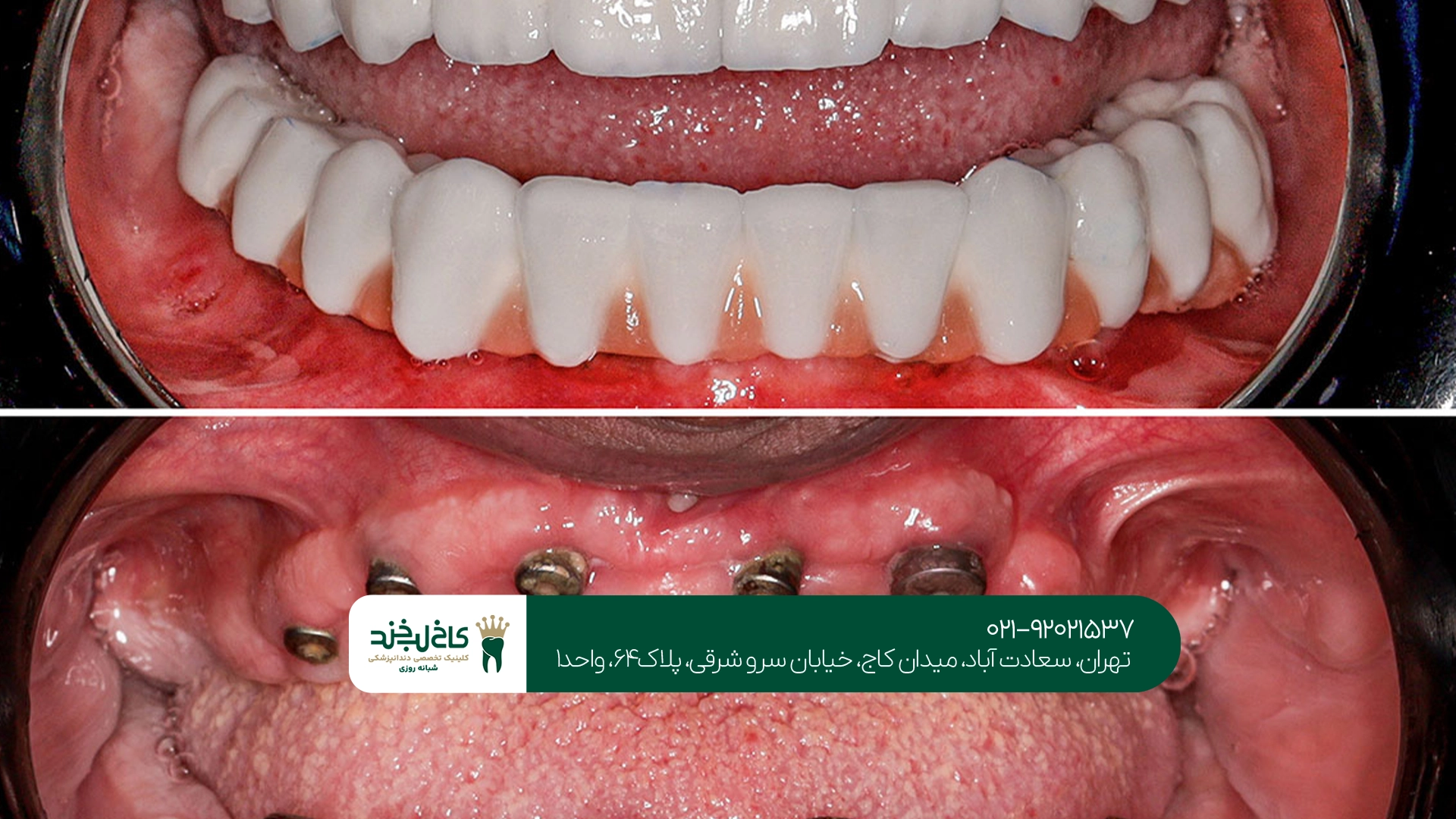 بهترین جایگزین دندان