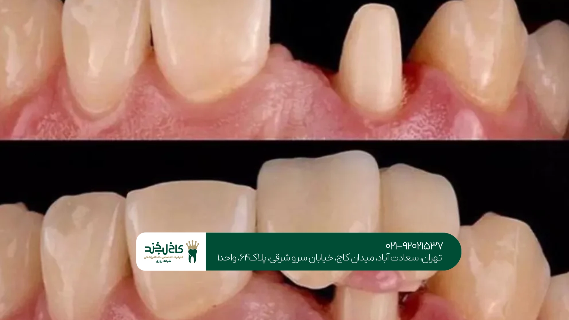 کاشت دندان یا بریج