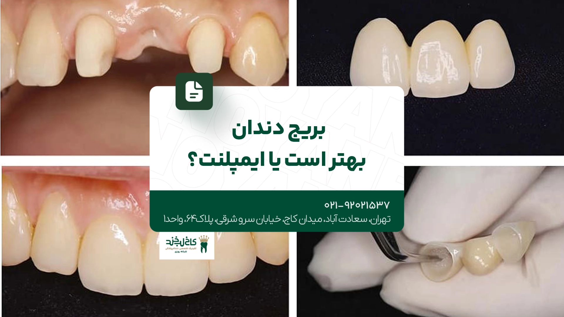 بریج دندان بهتر است یا ایمپلنت