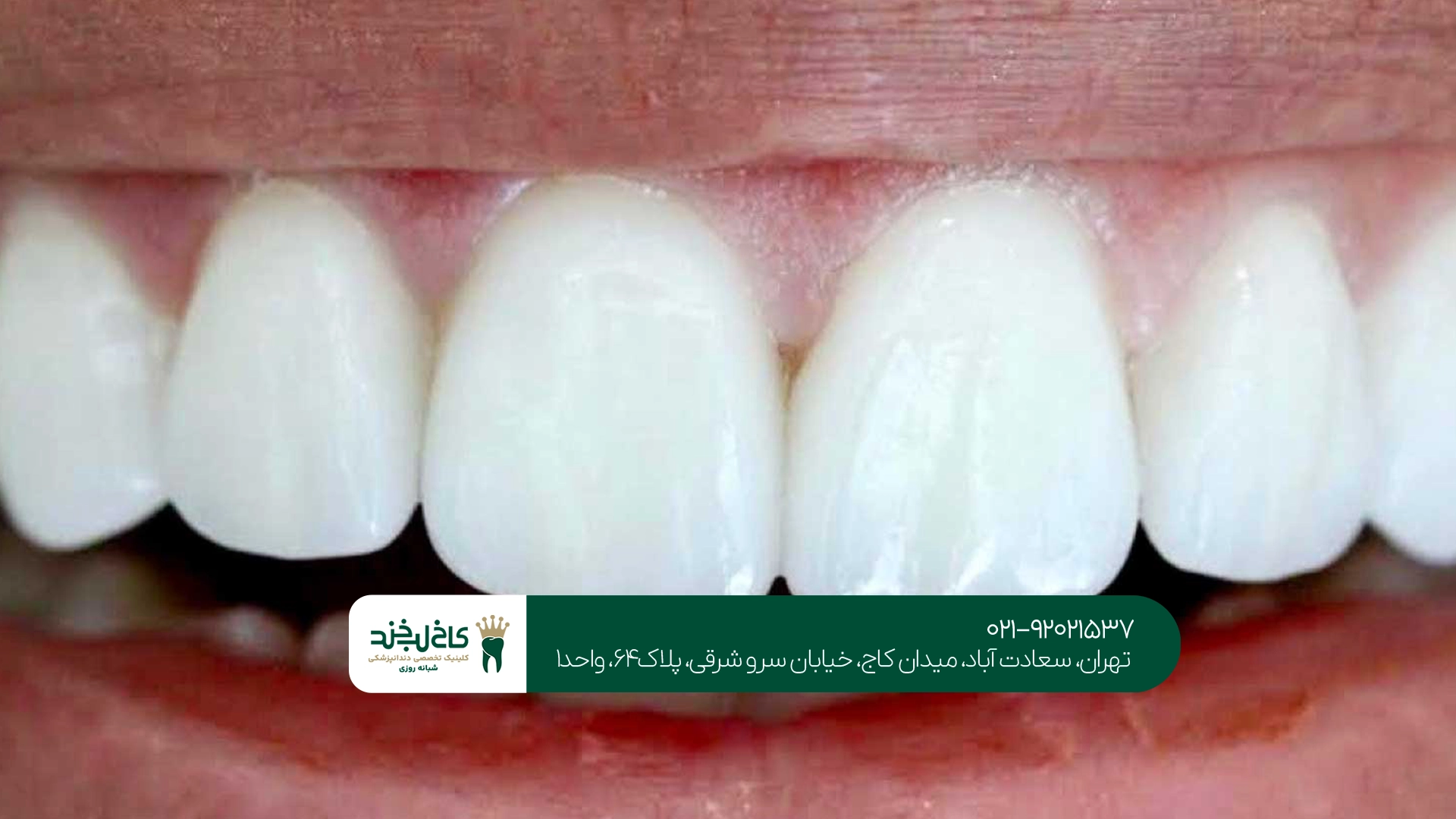 مزایا و معایب بلیچینگ دندان در مقایسه با کامپوزیت