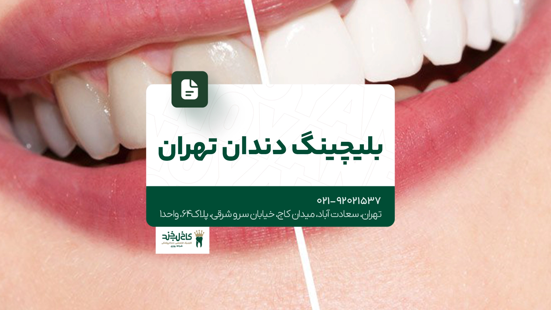 بلیچینگ دندان تهران
