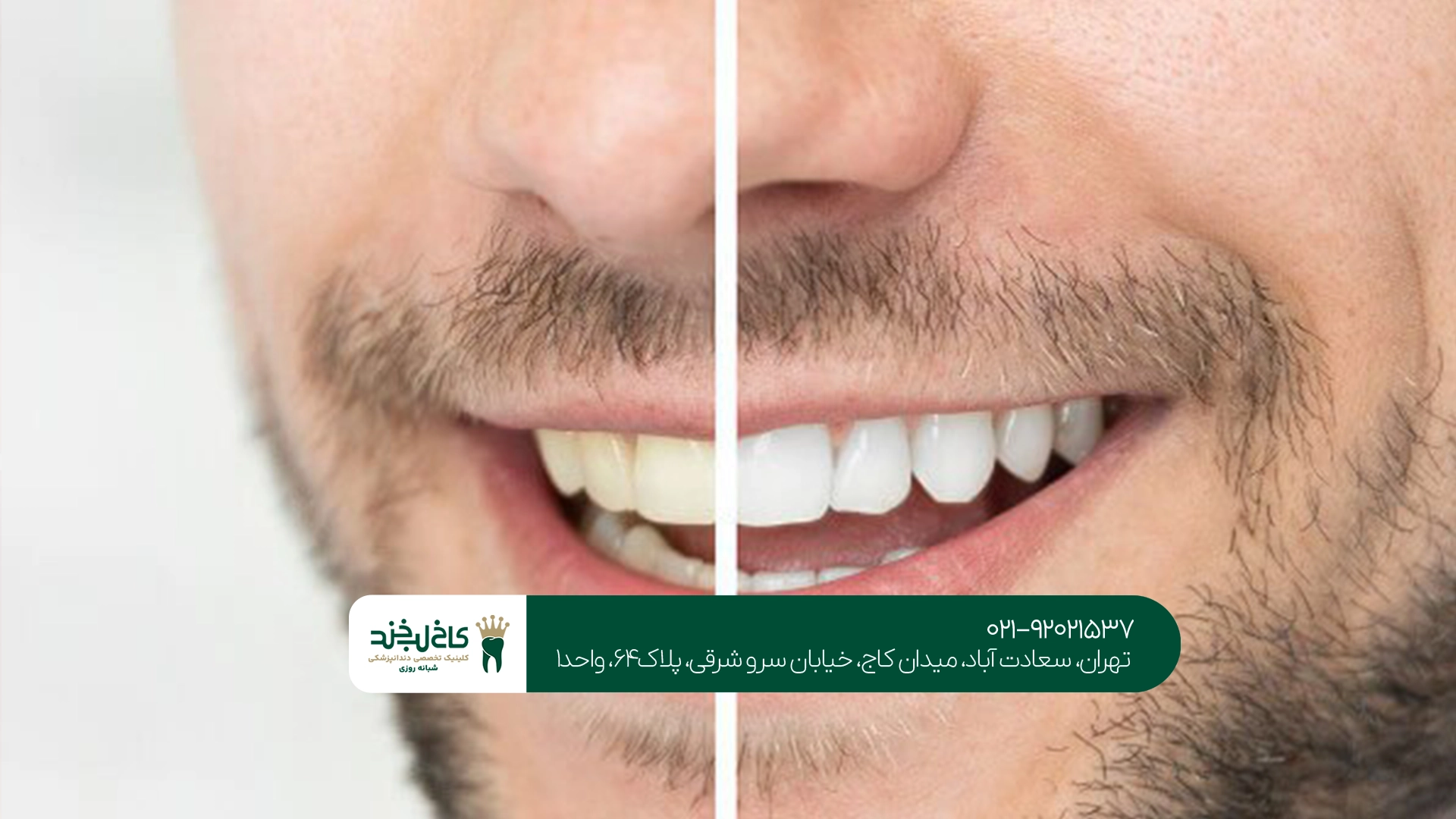 بلیچینگ دندان در تهران