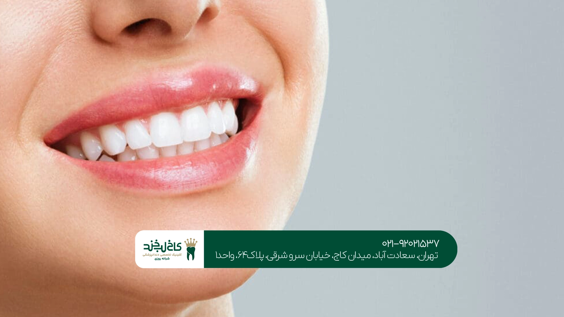 بلیچینگ دندان در تهران
