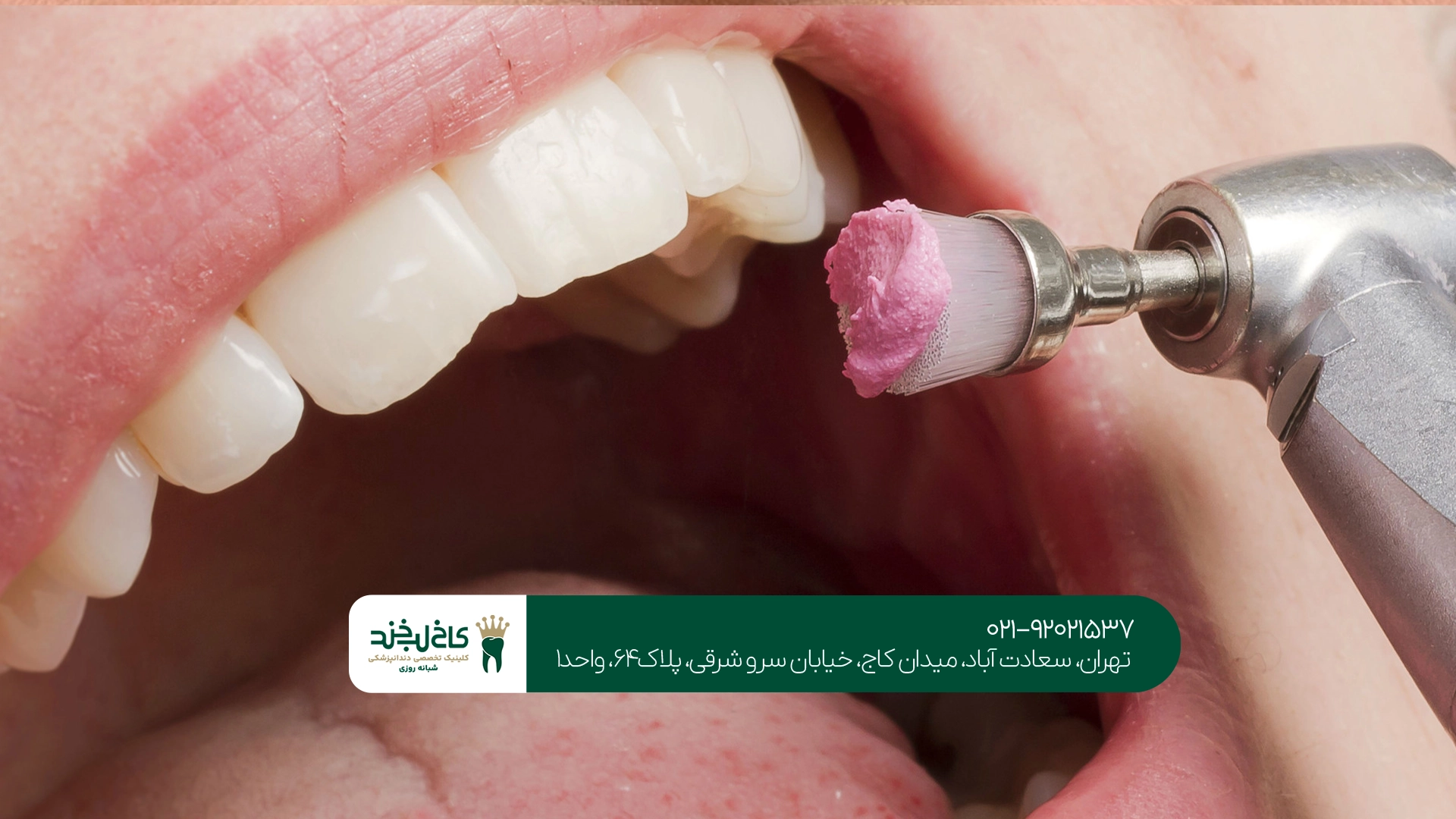 بلیچینگ دندان در تهران