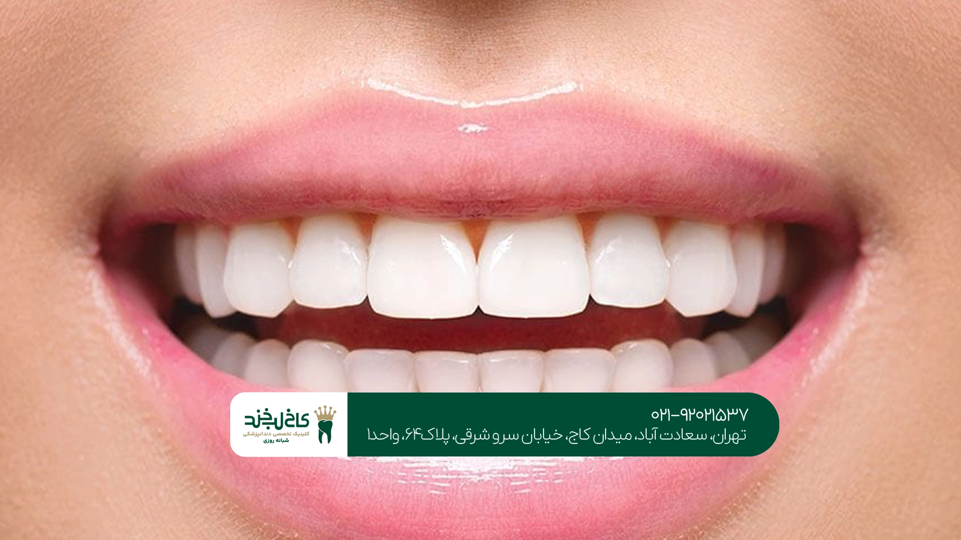بلیچینگ دندان در تهران