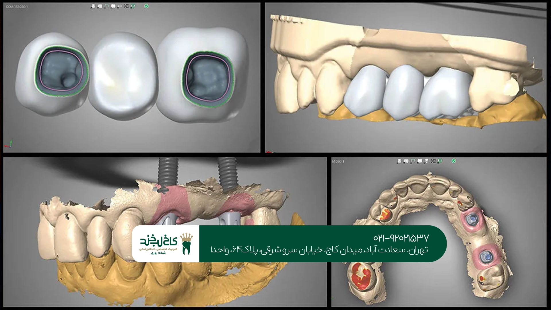 مرکز تخصصی ایمپلنت دیجیتال