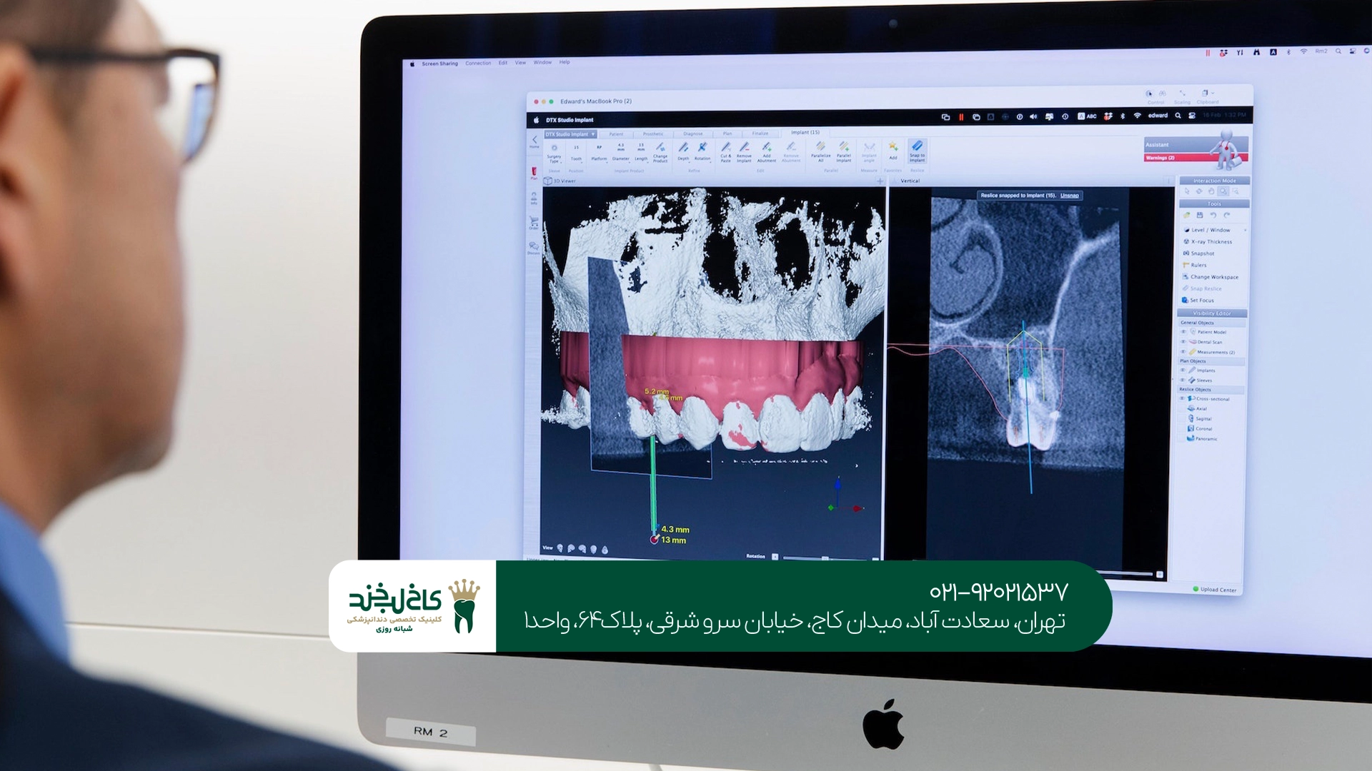 دقت ایمپلنت دیجیتال چقدر است؟