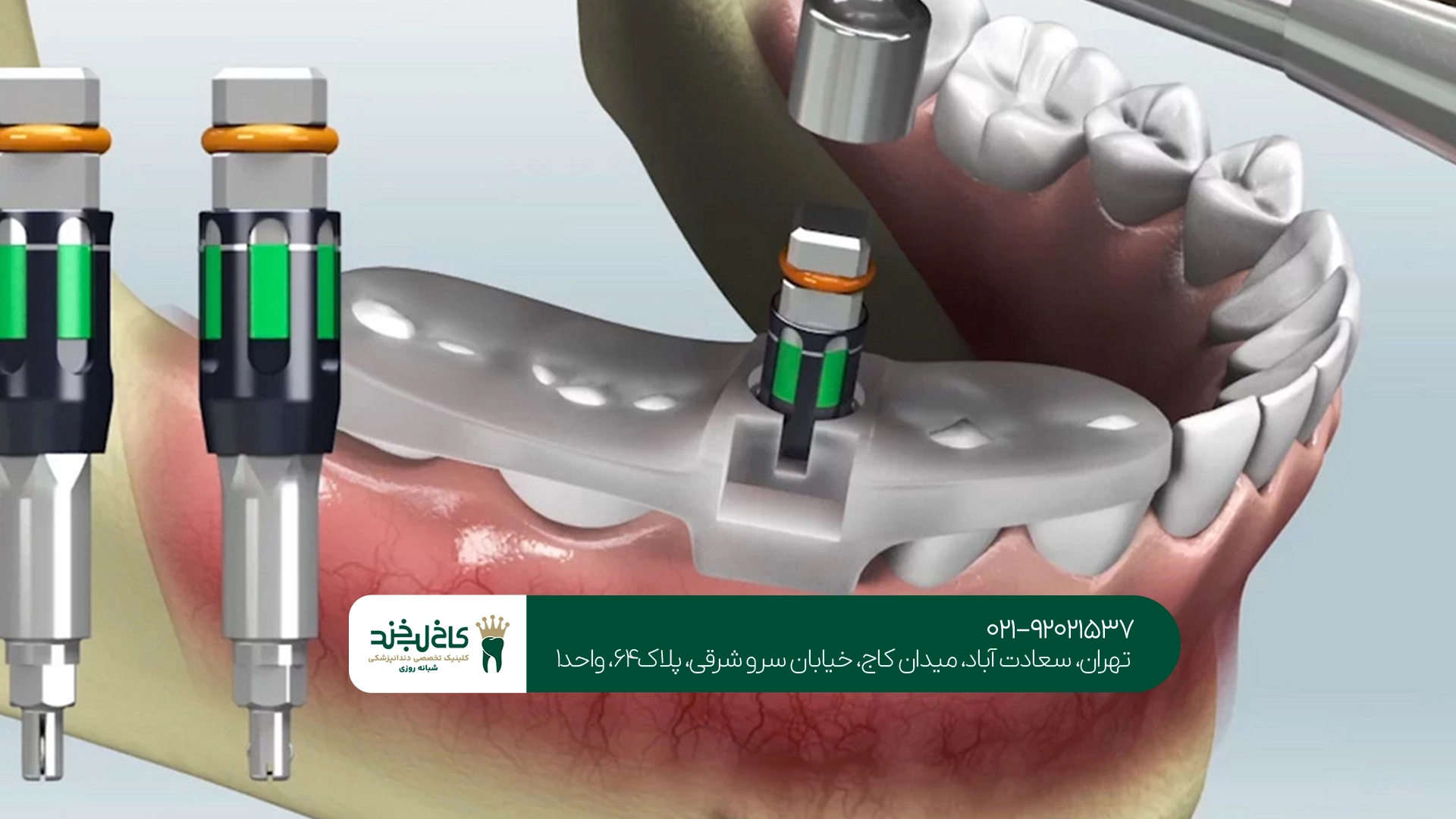 مزایای ایمپلنت دیجیتال نسبت به ایمپلنت سنتی