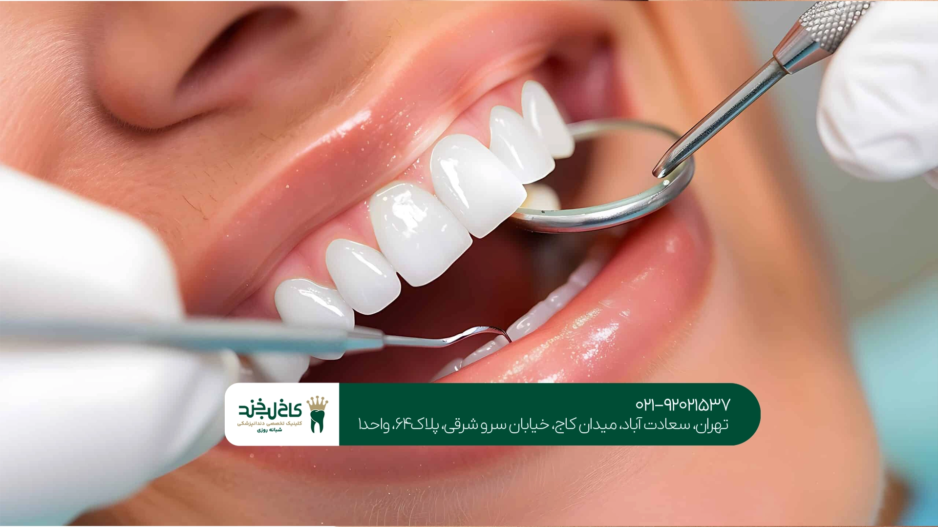 چرا تجربه دندانپزشک در نتیجه کامپوزیت اهمیت دارد؟