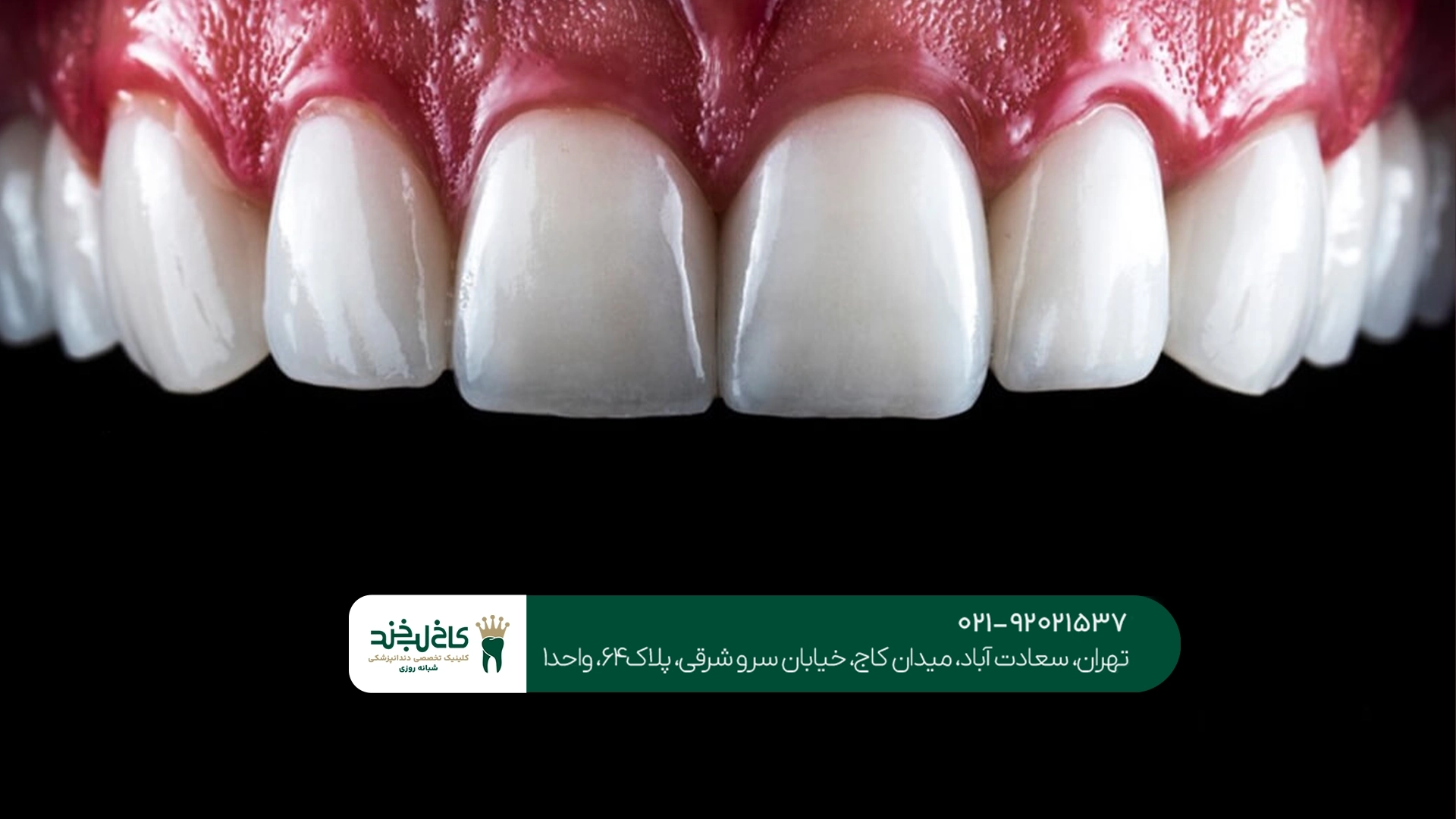 دکتر کامپوزیت تهران دکتر کامپوزیت تهران