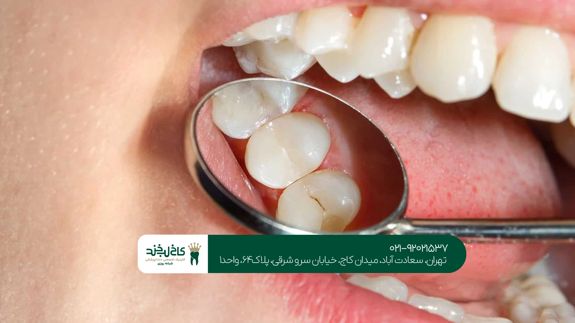 پر کردن دندان چیست؟