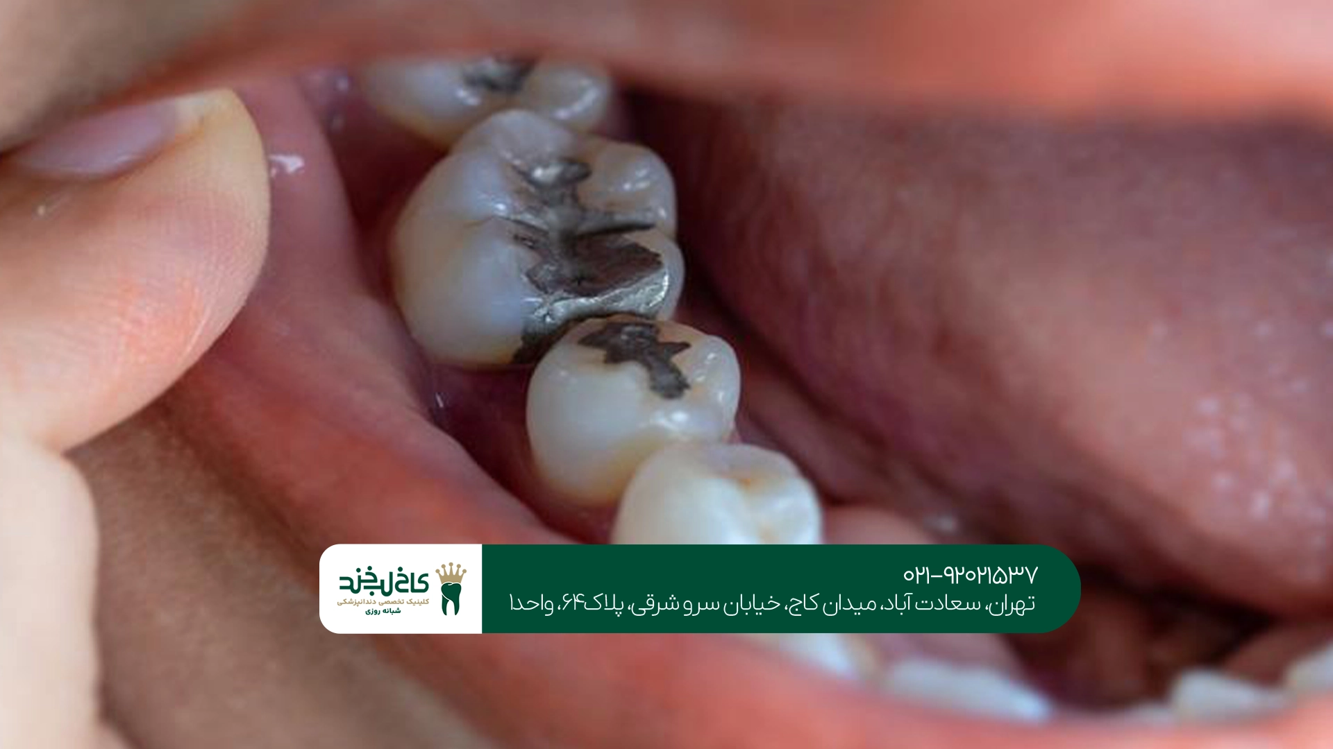 پر کردن دندان با سرامیک