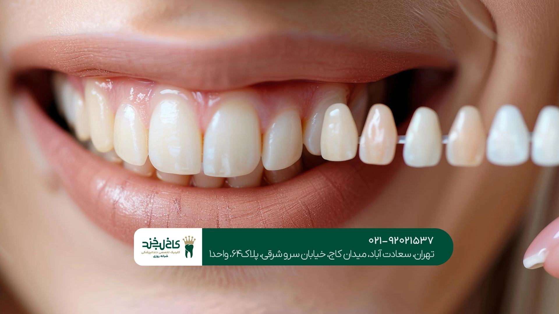 دندانپزشکی روکش دندان تهران