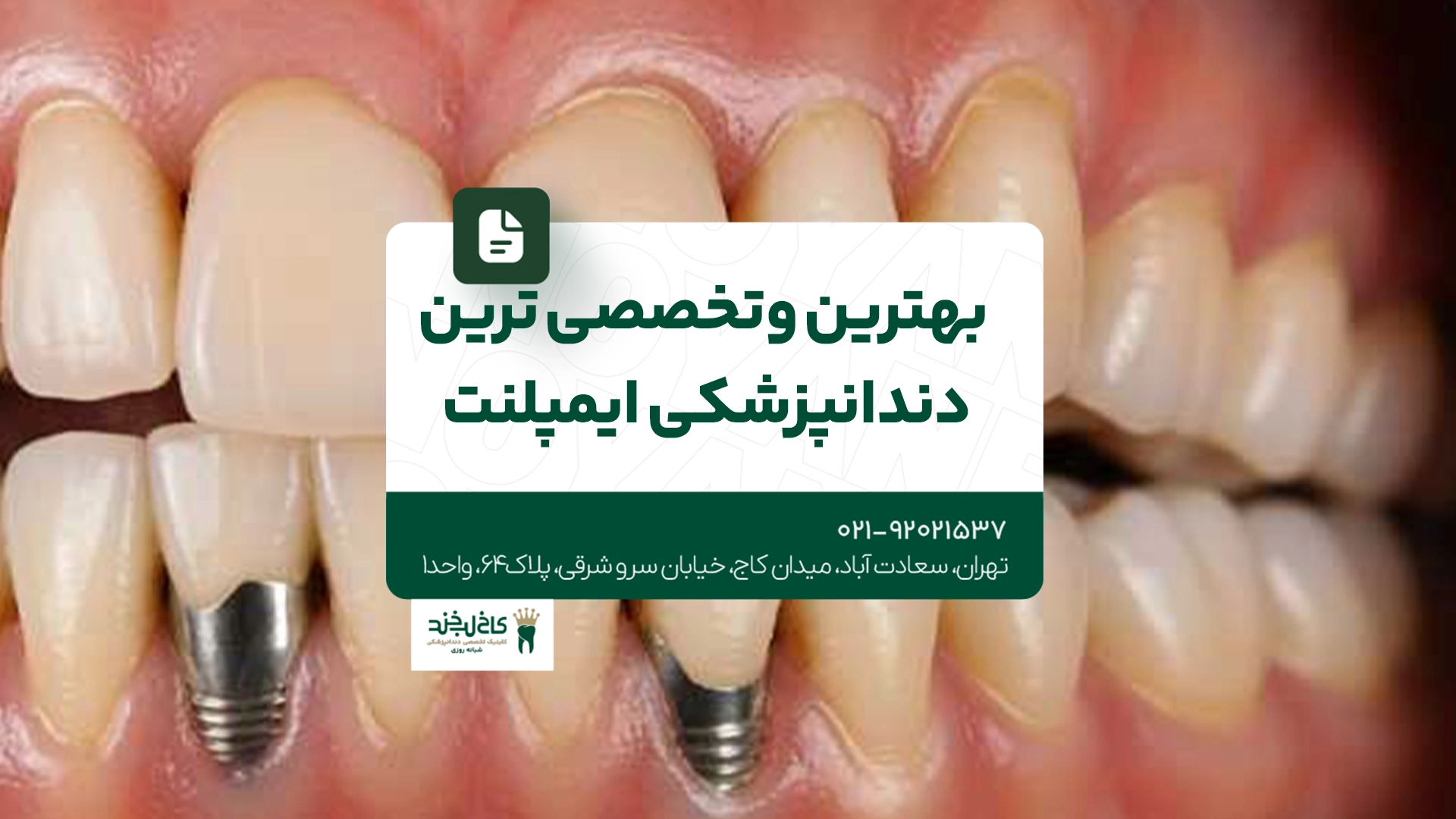 بهترین و تخصصی ترین دندانپزشکی ایمپلنت