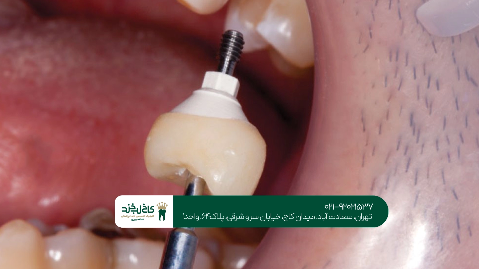 اهمیت تخصص و تجربه در موفقیت ایمپلنت دندان