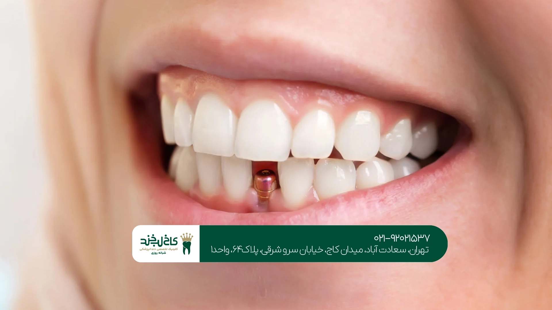 معیارهای تشخیص یک دندانپزشکی تخصصی ایمپلنت