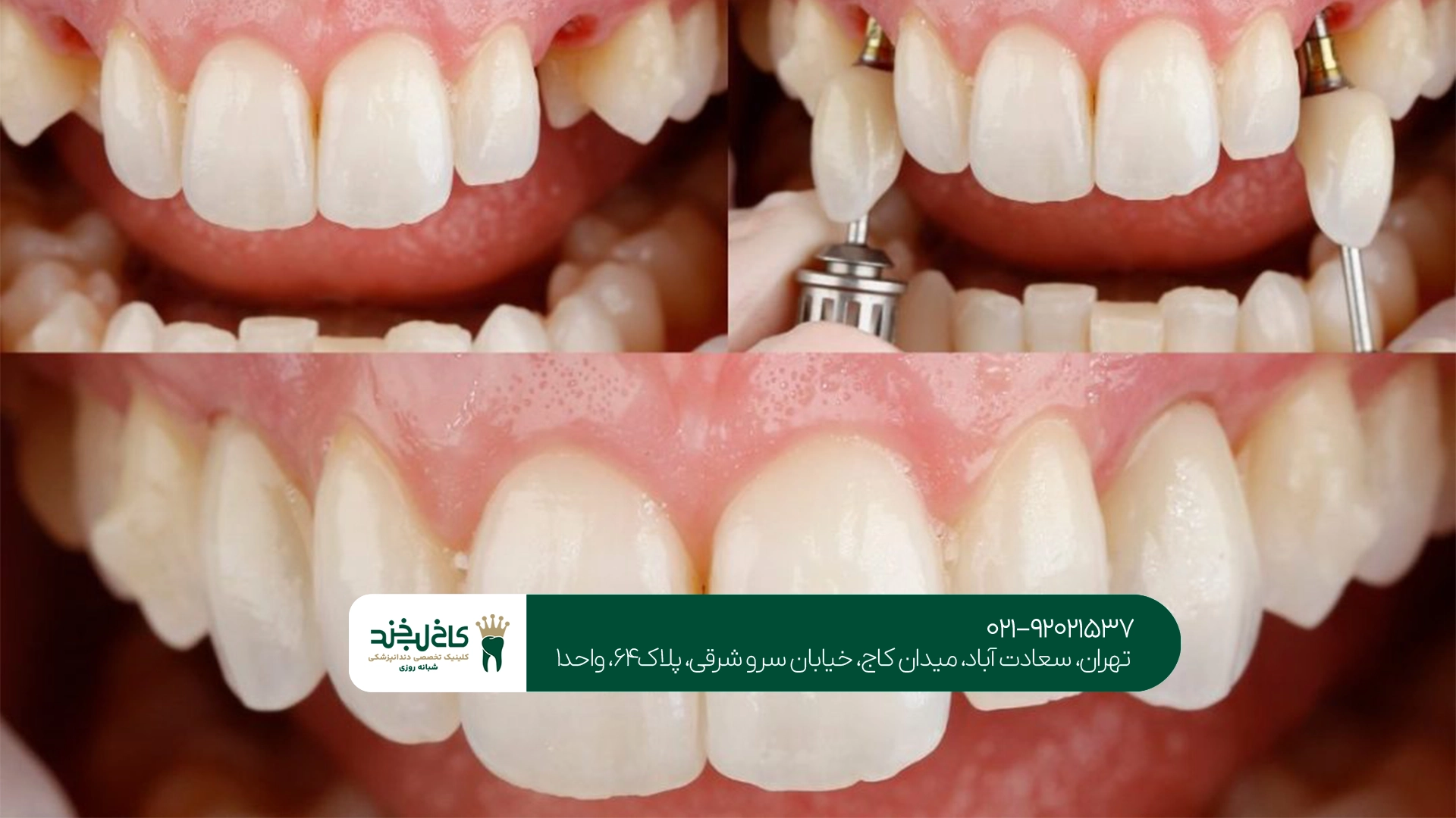 بهترین دندانپزشکی ایمپلنت