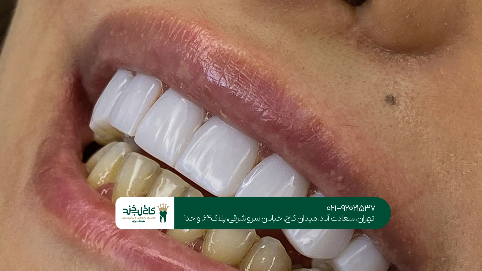 کامپوزیت دندان ارزان کامپوزیت دندان ارزان