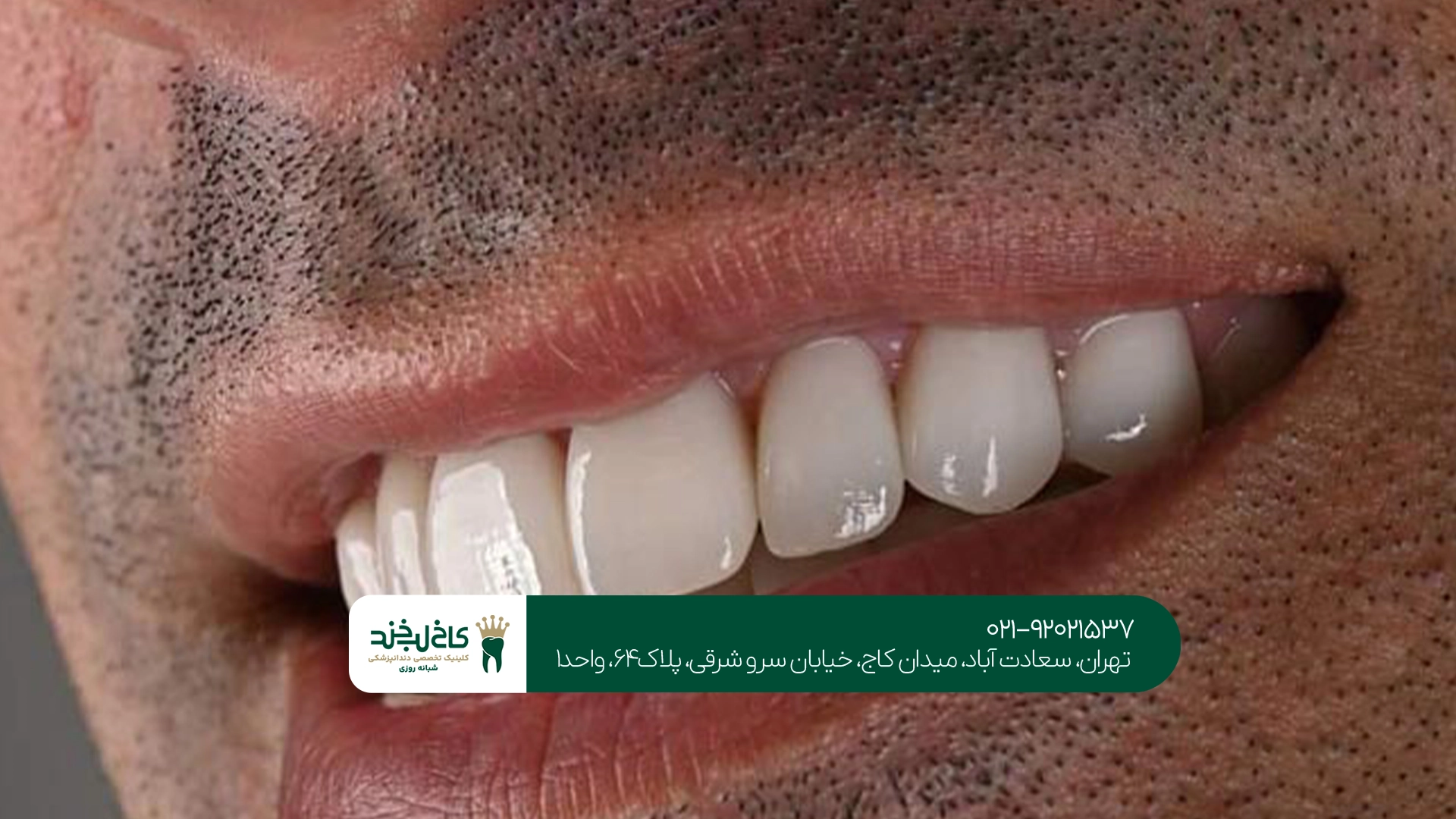 کامپوزیت دندان اقساطی تهران کامپوزیت دندان اقساطی تهران
