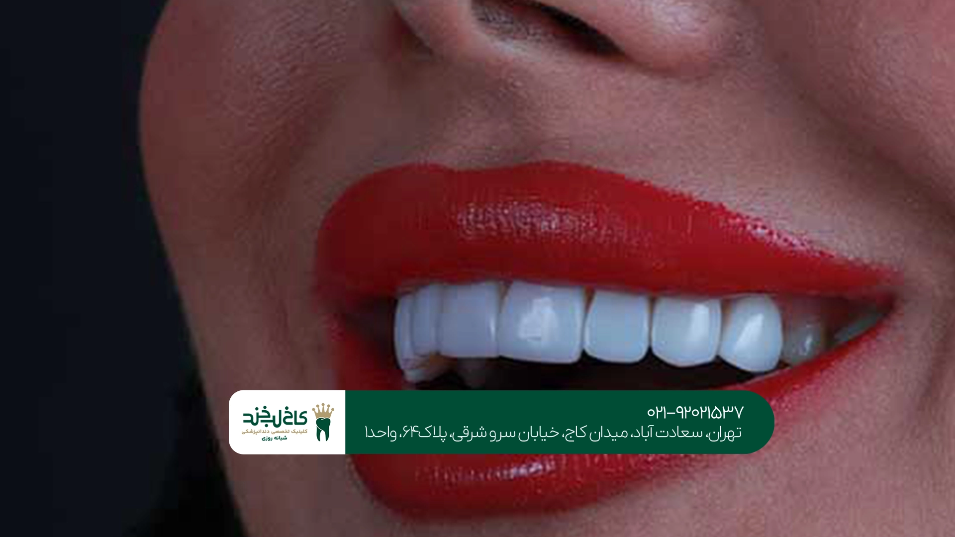 مرکز کامپوزیت دندان تهران مرکز کامپوزیت دندان تهران