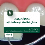 ترمیم کامپوزیت دندان شکسته در سعادت آباد