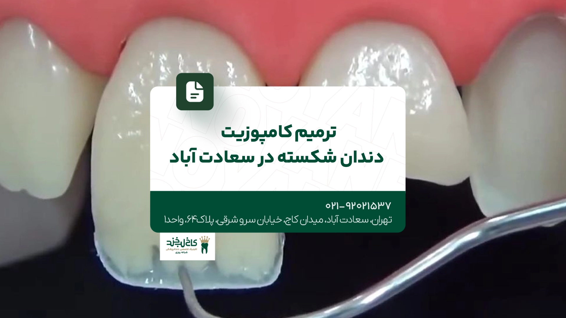 ترمیم کامپوزیت دندان شکسته در سعادت آباد
