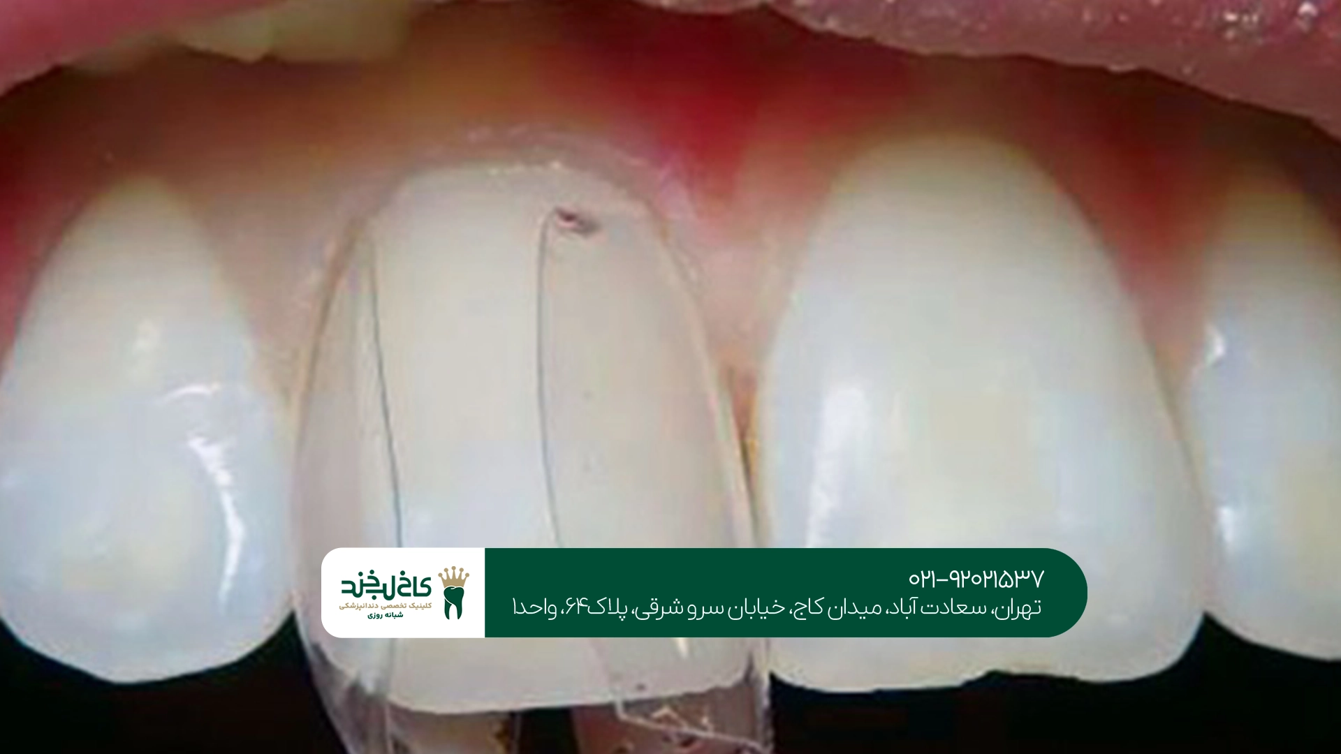 متخصص ترمیم کامپوزیت دندان