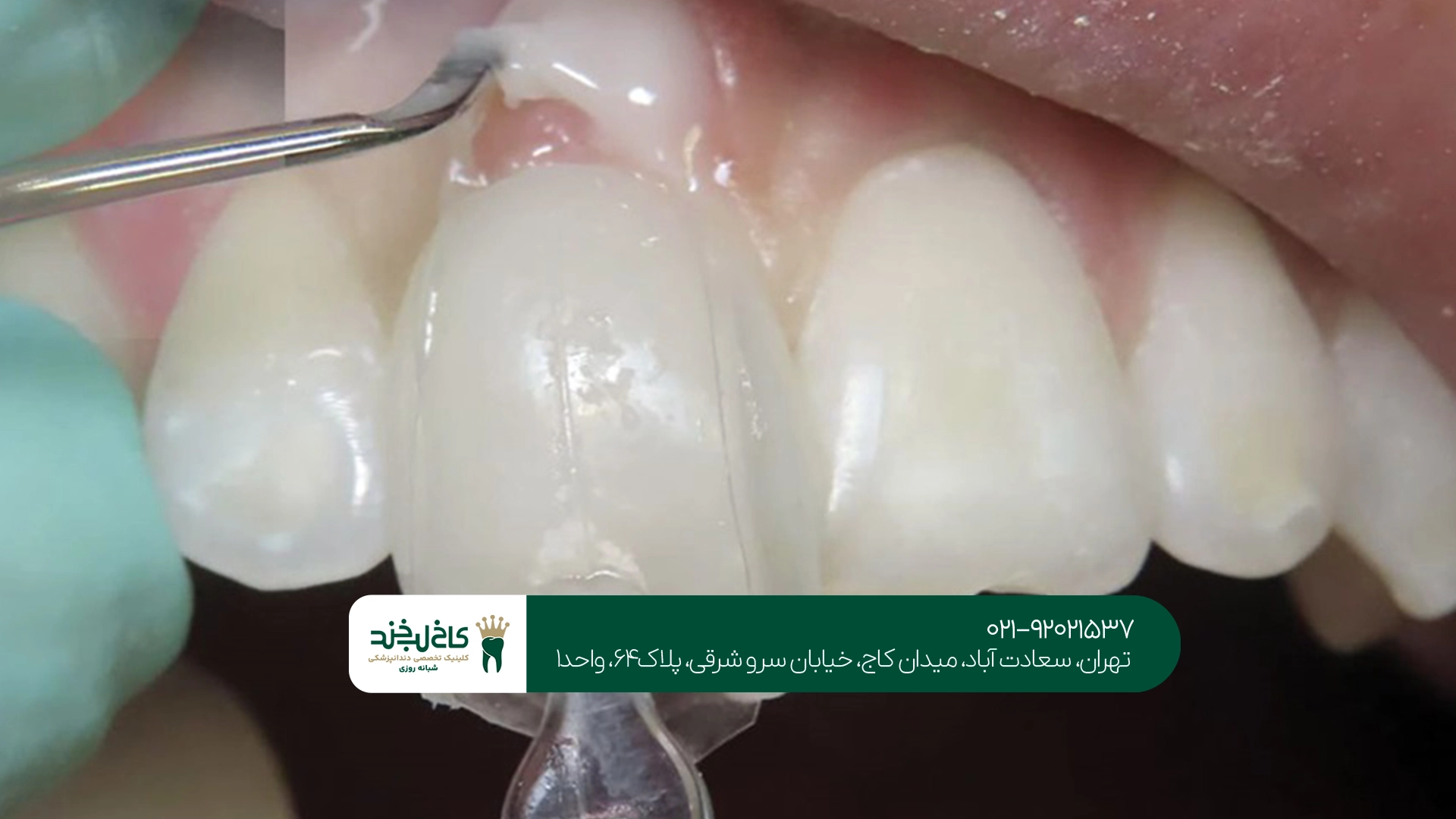ترمیم کامپوزیت دندان شکسته در سعادت آباد