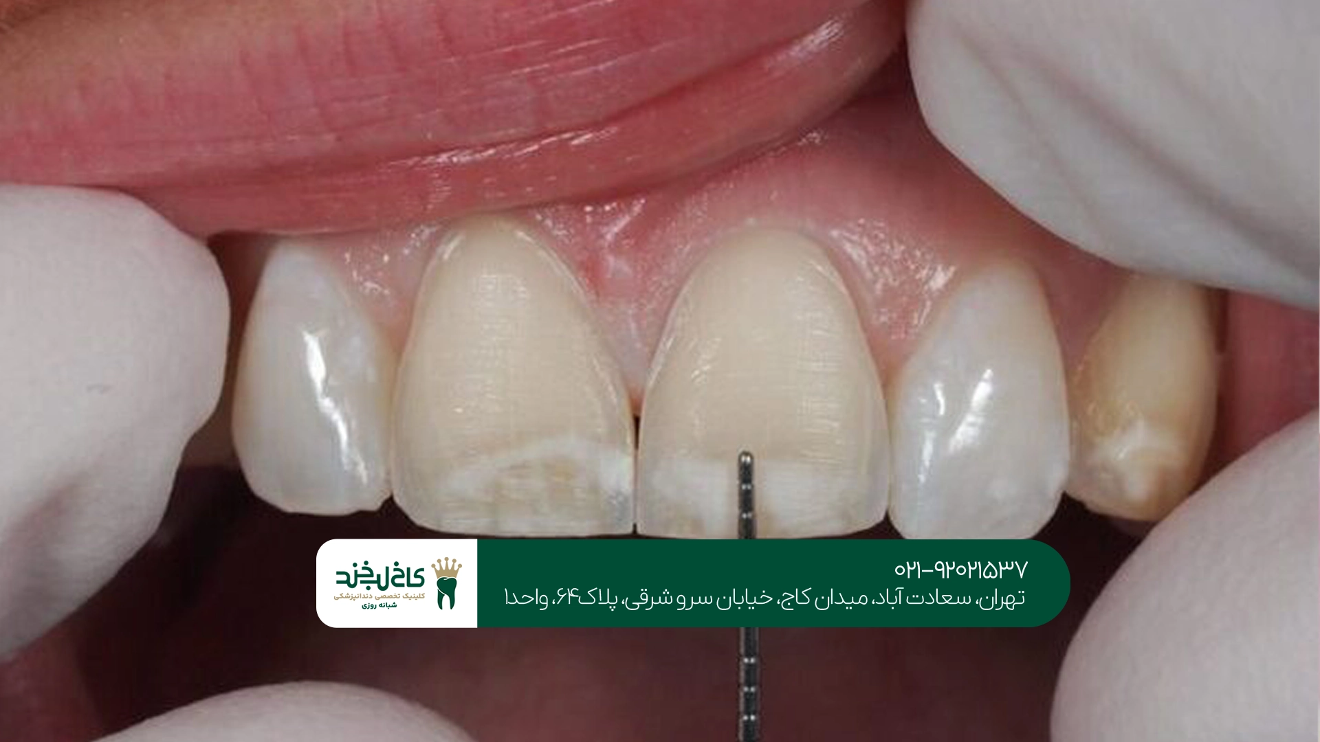 چه زمانی باید برای ترمیم کامپوزیت دندان شکسته اقدام کرد؟