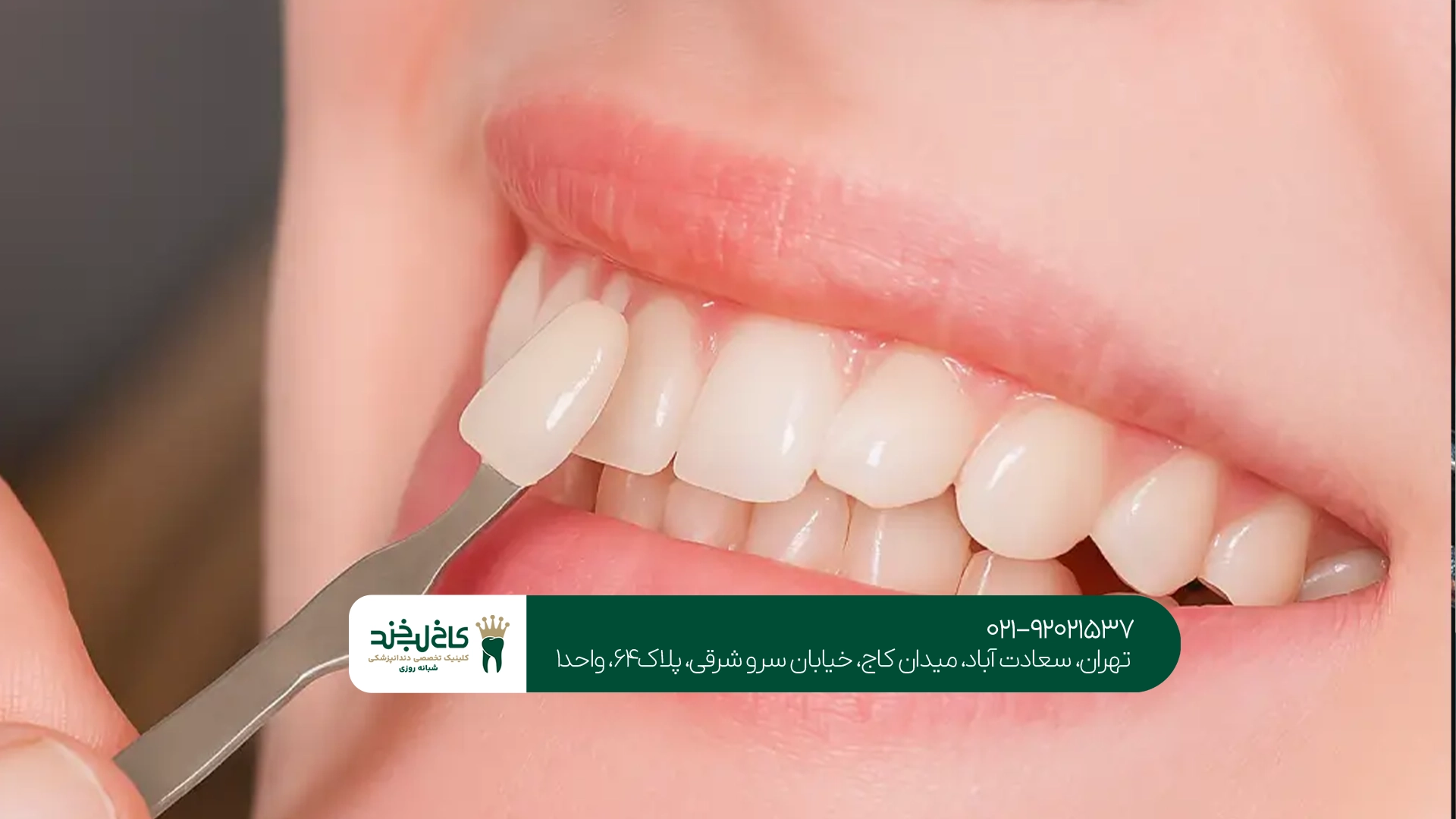 بهترین دندانپزشک تعویض لمینت