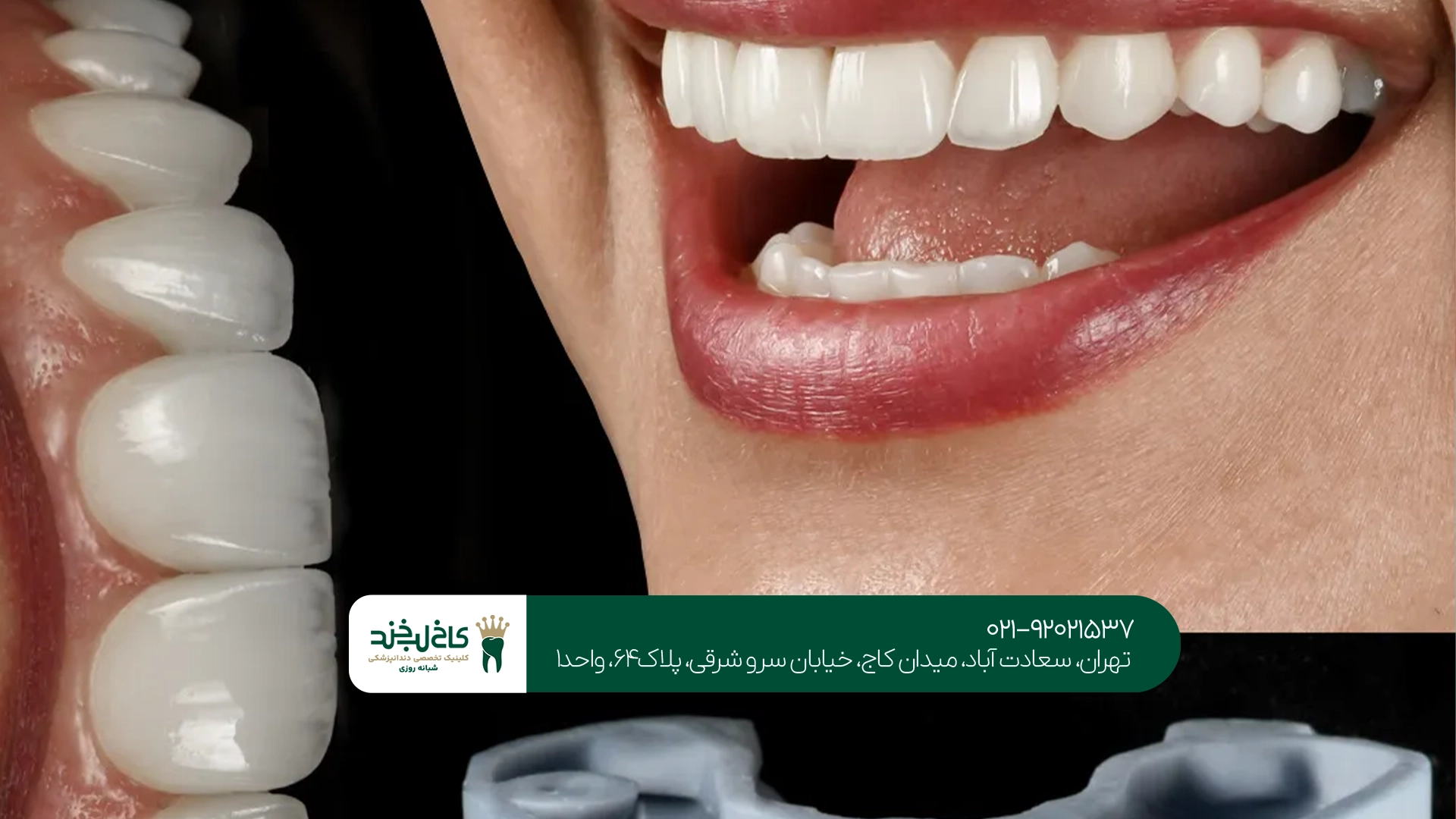 مراقبت بعد از تعویض لمینت دندان