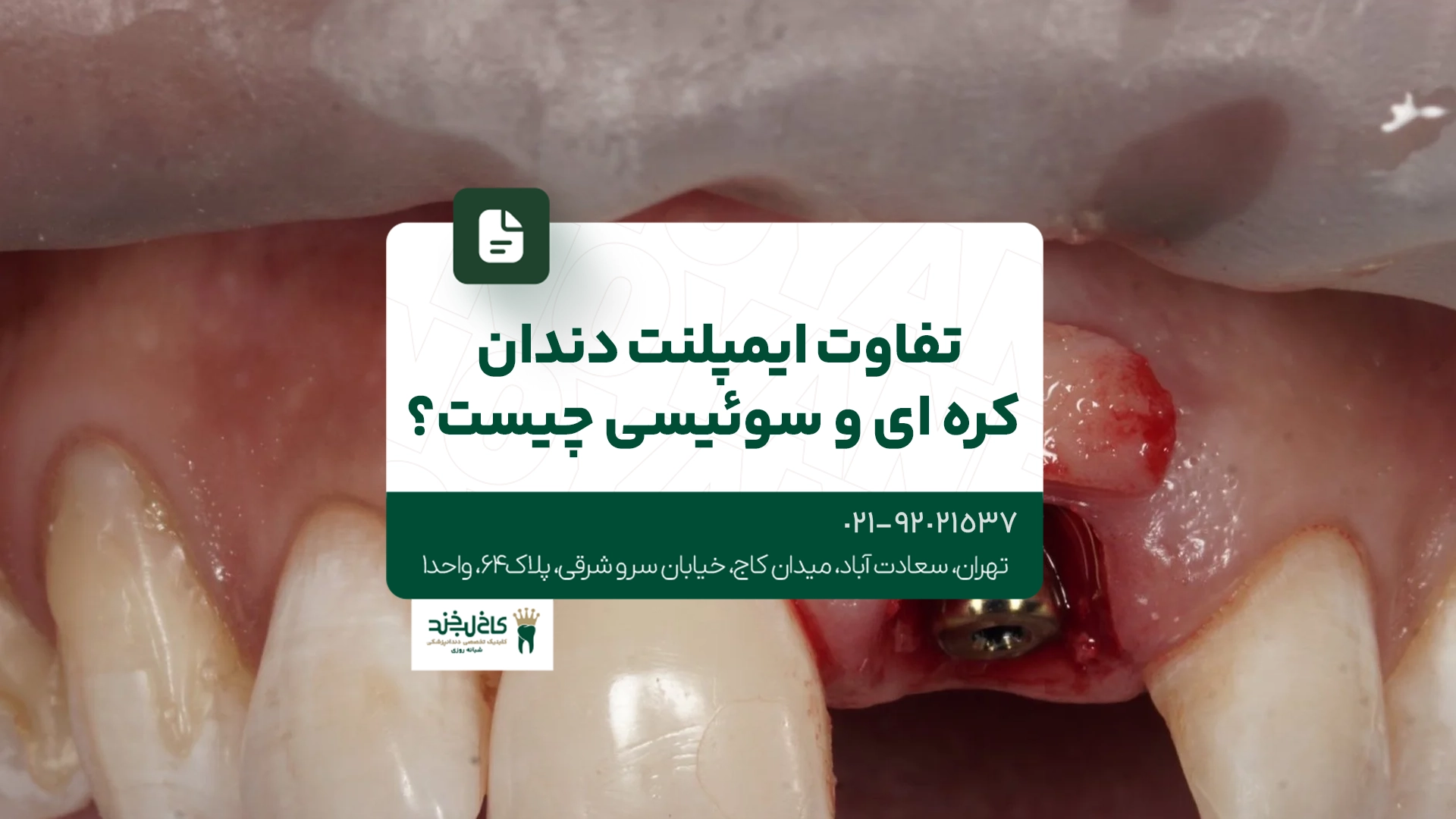 تفاوت ایمپلنت دندان کره ای و سوئیسی چیست