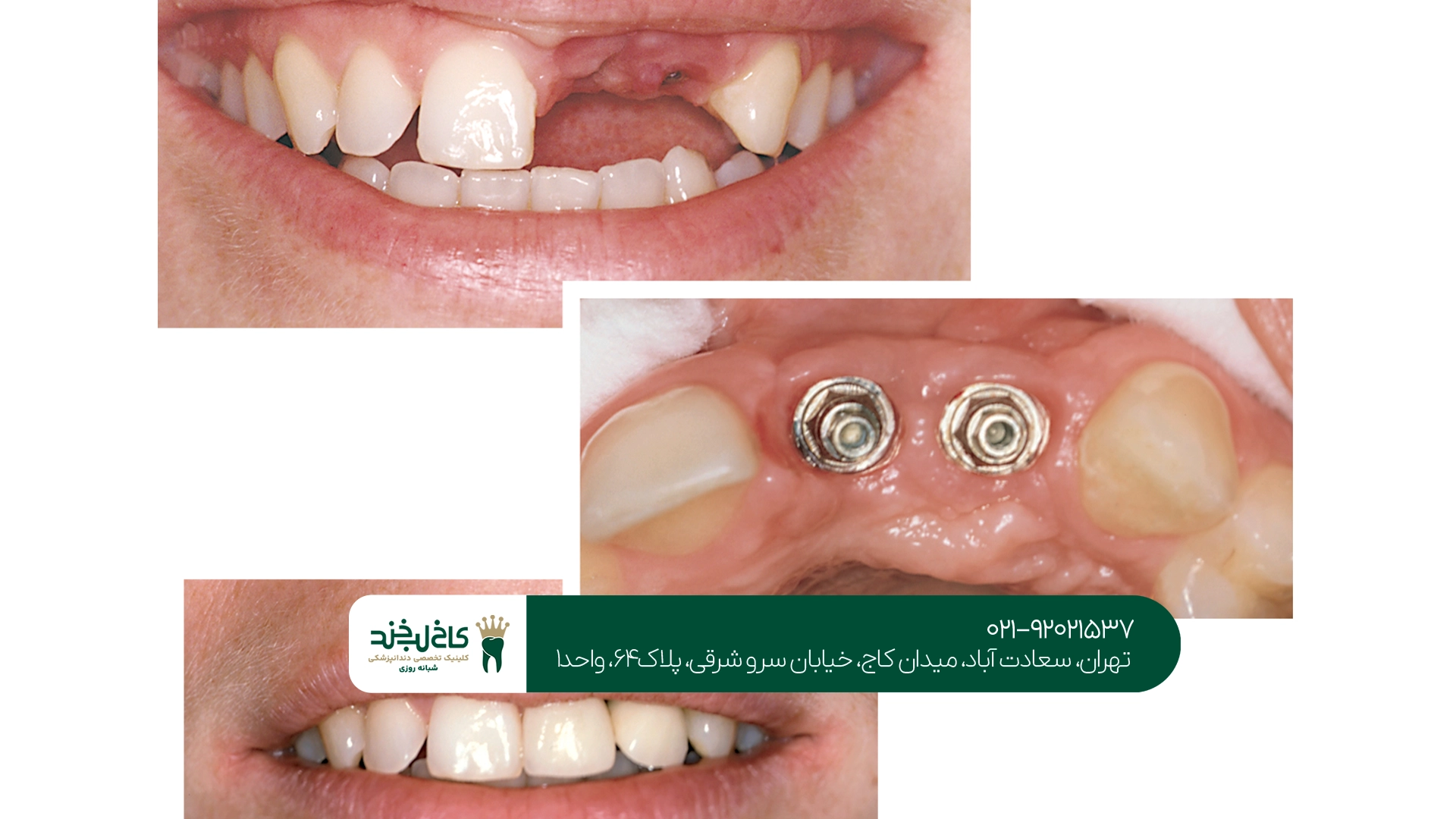 تفاوت ایمپلنت دندان کره ای و سوئیسی چیست