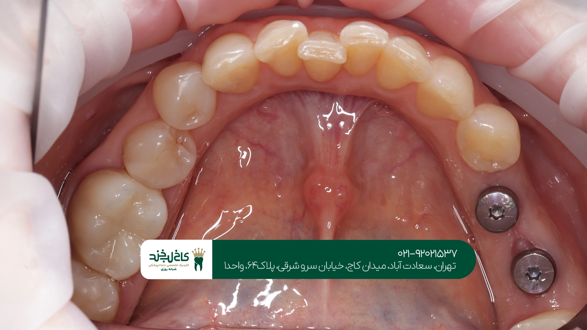 تفاوت ایمپلنت دندان کره ای و سوئیسی چیست