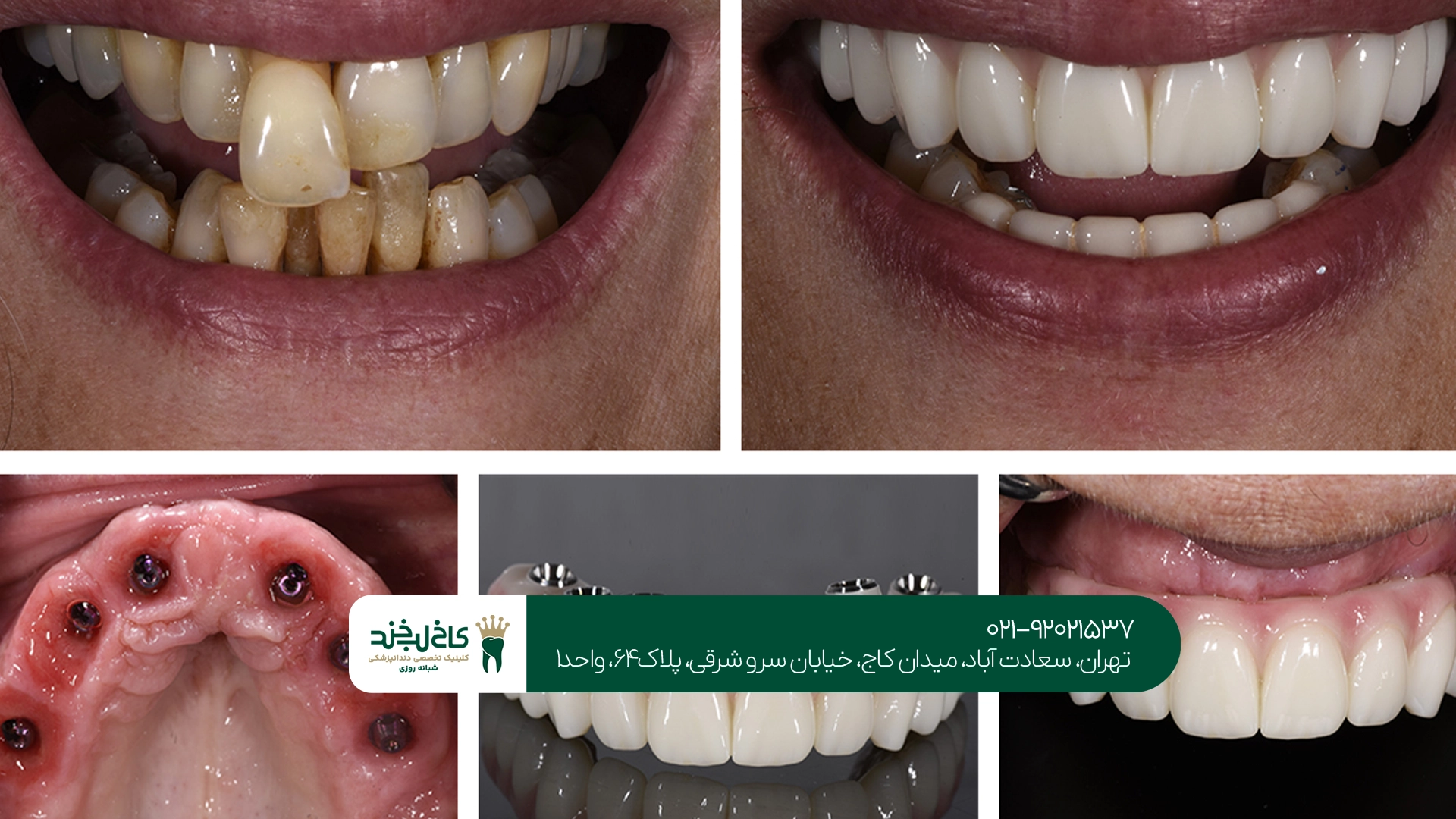 تفاوت ایمپلنت دندان کره ای و سوئیسی چیست