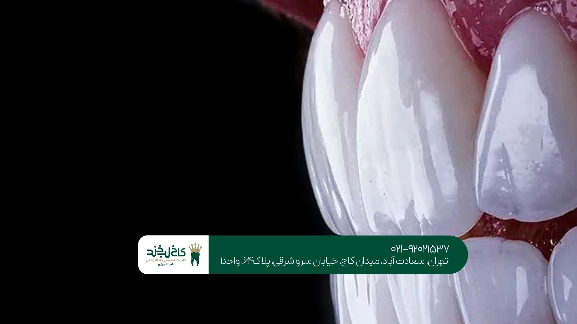 بهترین روکش دندان
