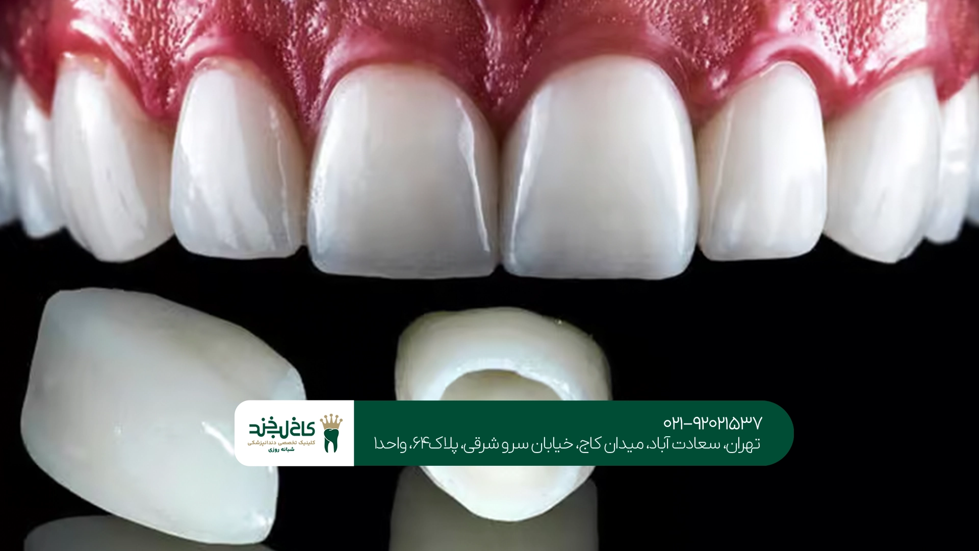 کاربردهای هر کدام از روکشهای زیرکونیا و PFM