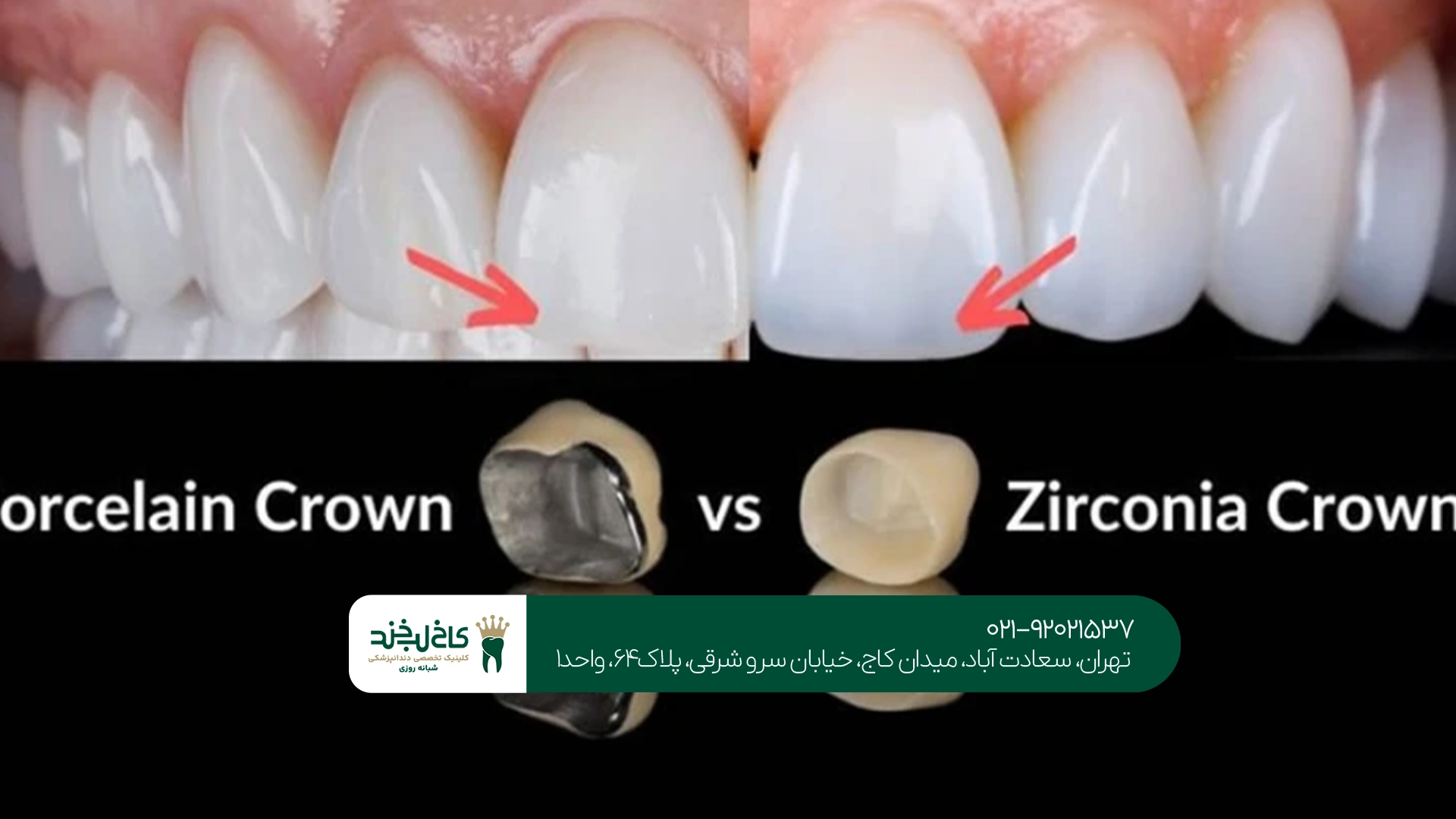 تفاوت ظاهر و زیبایی در روکش زیرکونیا و PFM