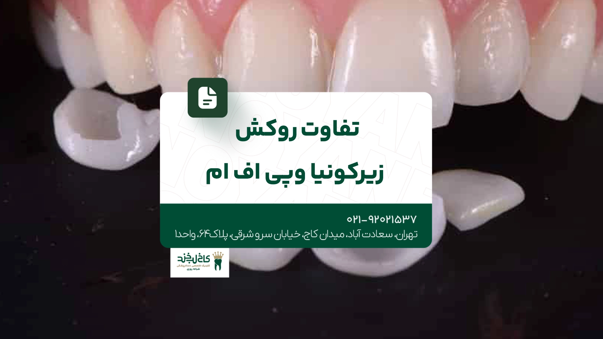 تفاوت روکش زیرکونیا و پی اف ام